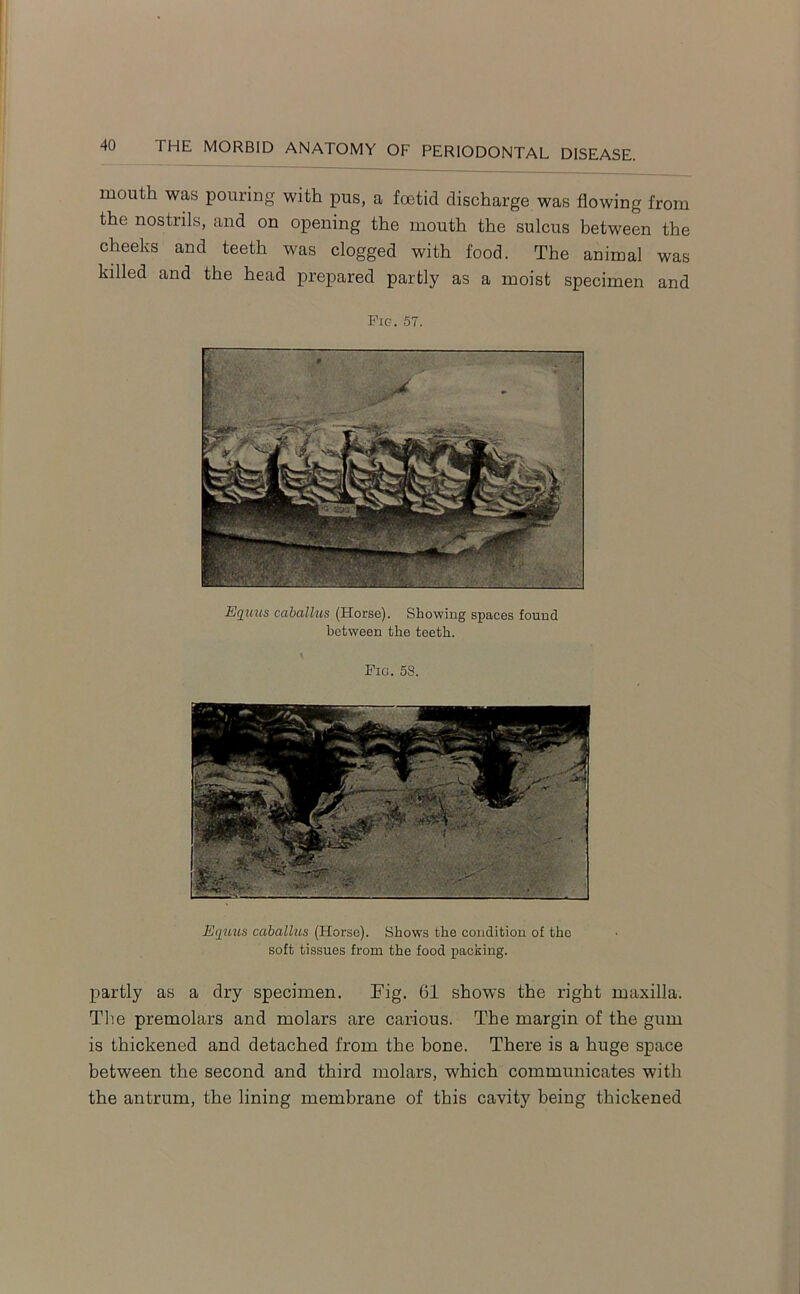 mouth was pouring with pus, a foetid discharge was flowing from the nostrils, and on opening the mouth the sulcus between the cheeks and teeth was clogged with food. The animal was killed and the head prepared partly as a moist specimen and Fig. 57. Equus caball-us (Horse). Showing spaces found between the teeth. Fig. 58. Equus cciballus (Horse). Shows the condition of the soft tissues from the food packing. partly as a dry specimen. Fig. 61 shows the right maxilla. The premolars and molars are carious. The margin of the gum is thickened and detached from the bone. There is a huge space between the second and third molars, which communicates with the antrum, the lining membrane of this cavity being thickened