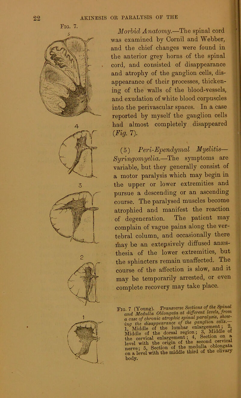 Fig. 7. Morbid Anatomy.—The spinal cord was examined by Cornil and Webber, and the chief changes were found in the anterior grey horns of the spinal cord, and consisted of disappearance and atrophy of the ganglion cells, dis- appearance of their processes, thicken- ing of the walls of the blood-vessels, and exudation of white blood corpuscles into the perivascular spaces. In a case reported by myself the ganglion cells bad almost completely disappeared {Fig. 7). (5) Peri-Ependymal Myelitis— Syringomyelia.—The symptoms are variable, but they generally consist of a motor paralysis which may begin in the upper or lower extremities and pursue a descending or an ascending course. The paralysed muscles become atrophied and manifest the reaction of degeneration. The patient may complain of vague pains along the ver- tebral column, and occasionally there may be an extensively diffused anaes- thesia of the lower extremities, but the sphincters remain unaffected. The course of the affection is slow, and it may be temporarily arrested, or even complete recovery may take place. Fig 7 (Young). Transverse Sections of the Spinal and Medulla Oblongata at different levels, from a case of chronic atrophic spinal paralysis, show- ing the disappearance of the ganglion celts. 1, Middle of the lumbar enlargement; l. Middle of the dorsal region; 3, Middle ot the cervical enlargement; 4, Section on a level with the origin of the second cervical nerve- 5. Section of the medulla oblongata on a level with the middle third of the olivary body.
