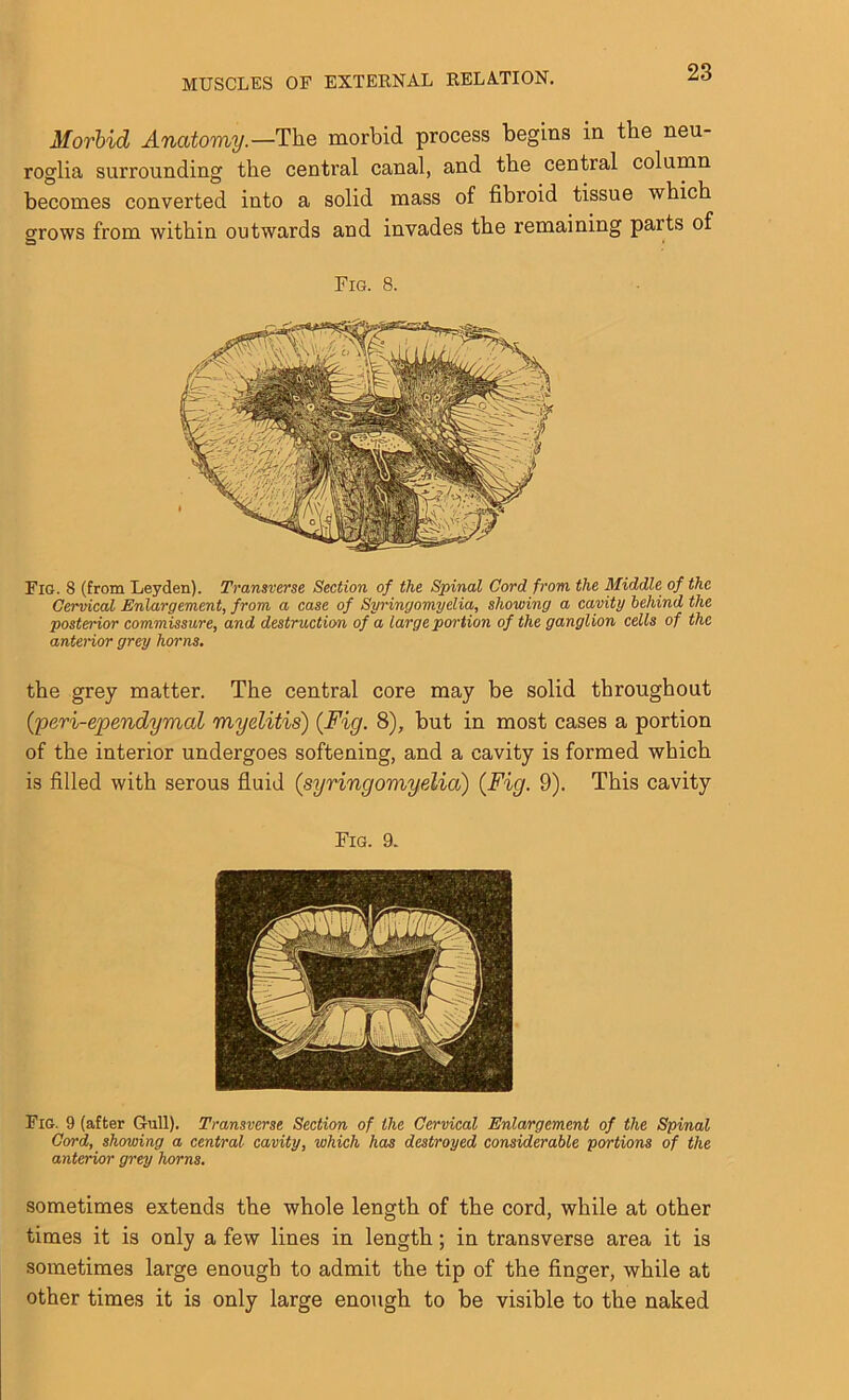 Morbid Anatomy.—Tlie morbid process begins in the neu- roglia surrounding the central canal, and the central column becomes converted into a solid mass of fibroid tissue which grows from within outwards and invades the remaining parts of a Fig. 8. Fig. 8 (from Leyden). Transverse Section of the Spinal Cord from the Middle of the Cervical Enlargement, from a case of Syringomyelia, showing a cavity behind the posterior commissure, and destruction of a large portion of the ganglion cells of the anterior grey horns. the grey matter. The central core may be solid throughout (;peri-ependymal myelitis) {Fig. 8), but in most cases a portion of the interior undergoes softening, and a cavity is formed which is filled with serous fluid (,syringomyelia) {Fig. 9). This cavity Fig. 9. Fig. 9 (after Gull). Transverse Section of the Cervical Enlargement of the Spinal Cord, showing a central cavity, which has destroyed considerable portions of the anterior grey horns. sometimes extends the whole length of the cord, while at other times it is only a few lines in length; in transverse area it is sometimes large enough to admit the tip of the finger, while at other times it is only large enough to be visible to the naked
