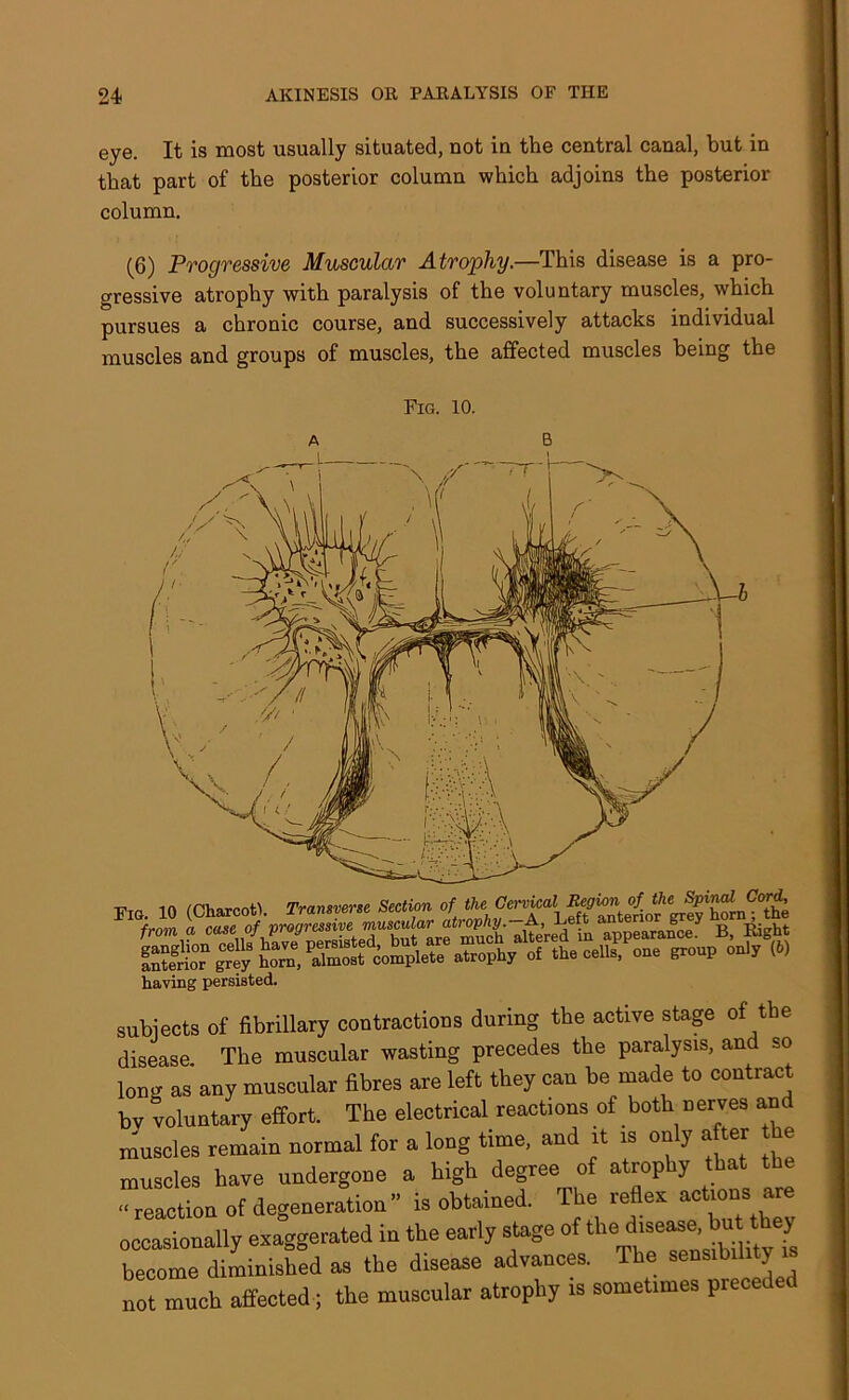 eye. It is most usually situated, not in the central canal, but in that part of the posterior column which adjoins the posterior column. (6) Progressive Muscular Atrophy.—This disease is a pro- gressive atrophy with paralysis of the voluntary muscles, which pursues a chronic course, and successively attacks individual muscles and groups of muscles, the affected muscles being the Fig. 10. Fig. 10 (Charcot!. Transverse Section of the he having persisted. subiects of fibrillary contractions during the active stage of the disease. The muscular wasting precedes the paralysis, and so long as any muscular fibres are left they can be made to contract by voluntary effort. The electrical reactions of both nerves and muscles remain normal for a long time, and it is only after the muscles have undergone a high degree of atrop y a ■■ reaction of degeneration ” is obtained. The reflex actions ar occasionally exaggerated in the early stage of *e drsea^ but Aey become diminished as the disease advances. The sensibility is not much affected ; the muscular atrophy is sometimes preceded