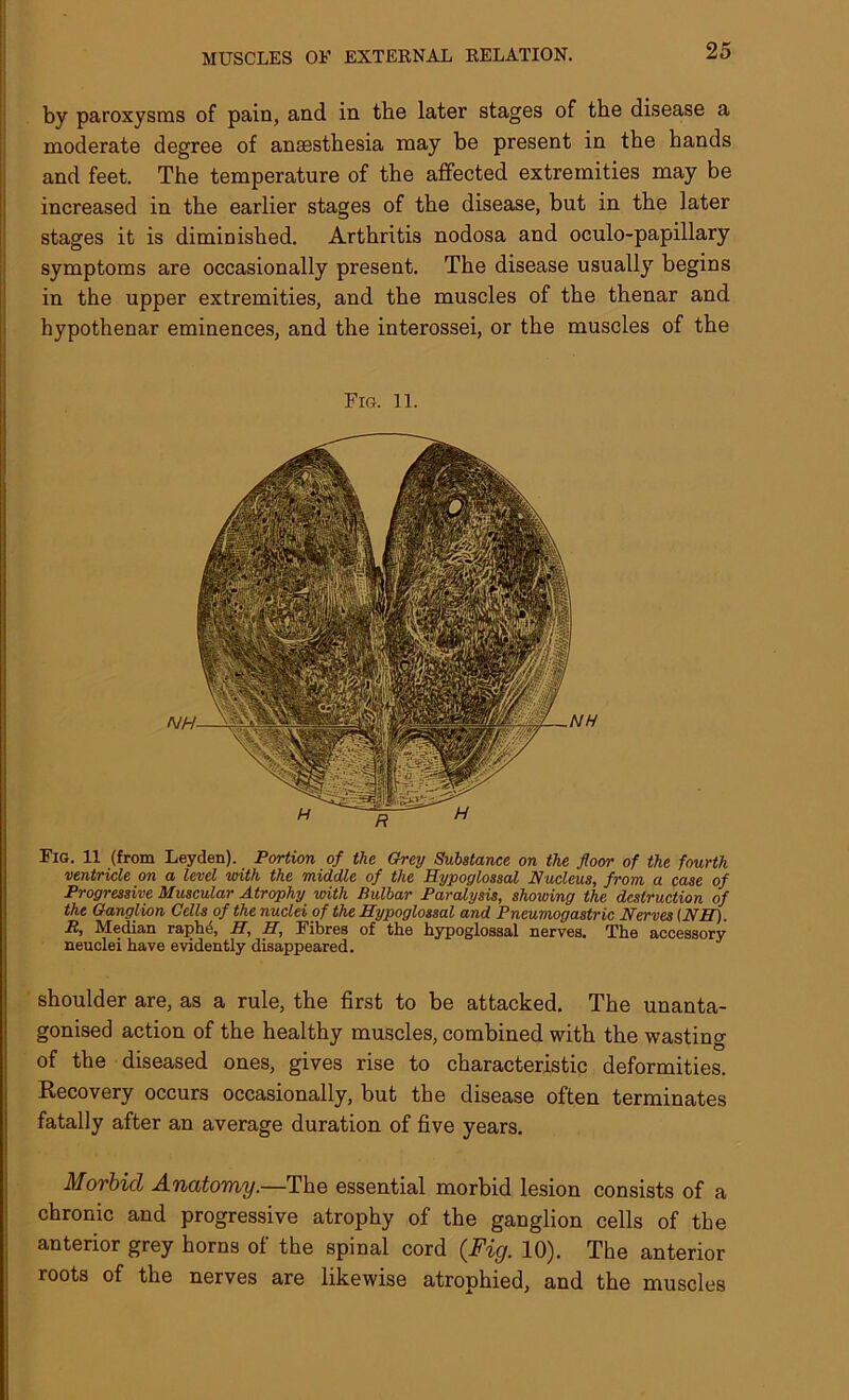 by paroxysms of pain, and in the later stages of the disease a moderate degree of anaesthesia may be present in the hands and feet. The temperature of the affected extremities may be increased in the earlier stages of the disease, but in the later stages it is diminished. Arthritis nodosa and oculo-papillary symptoms are occasionally present. The disease usually begins in the upper extremities, and the muscles of the thenar and hypothenar eminences, and the interossei, or the muscles of the Fig. 11. Fig. 11 (from Leyden). Portion of the Grey Substance on the floor of the fourth ventricle on a level with the middle of the Hypoglossal Nucleus, from a case of Progressive Muscular Atrophy with Bulbar Paralysis, showing the destruction of the Ganglion Cells of the nuclei of the Hypoglossal and Pneumogastric Nerves [NH). R, Median raphd, H, H, Fibres of the hypoglossal nerves. The accessory neuclei have evidently disappeared. shoulder are, as a rule, the first to be attacked. The unanta- gonised action of the healthy muscles, combined with the wasting of the diseased ones, gives rise to characteristic deformities. Recovery occurs occasionally, but the disease often terminates fatally after an average duration of five years. Morbid Anatomy.—The essential morbid lesion consists of a chronic and progressive atrophy of the ganglion cells of the anterior grey horns of the spinal cord (Fig. 10). The anterior roots of the nerves are likewise atrophied, and the muscles