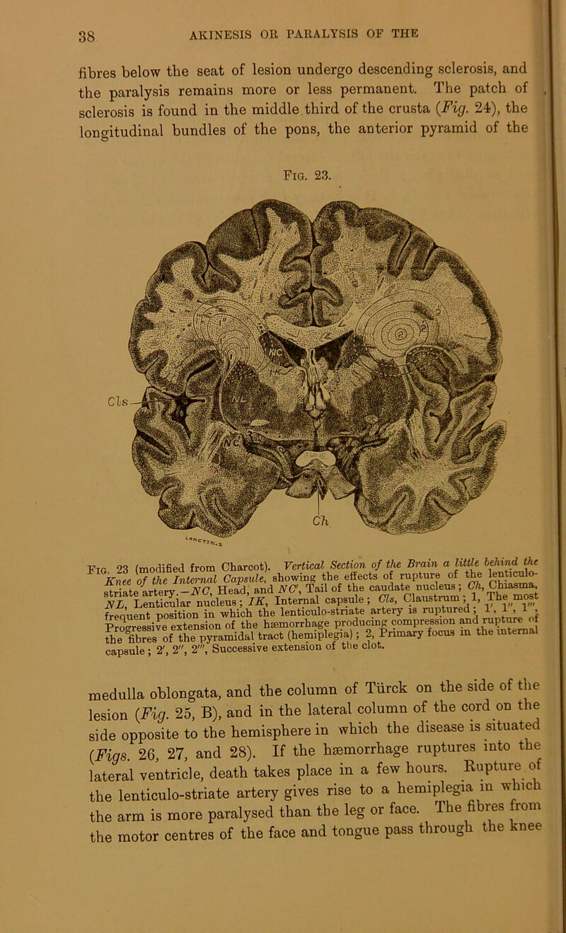 fibres below the seat of lesion undergo descending sclerosis, and the paralysis remains more or less permanent. The patch of sclerosis is found in the middle third of the crusta {Fig. 24), the longitudinal bundles of the pons, the anterior pyramid of the Fig. 23. Fig 23 (modified from Charcot). Vertical Section of the Brain a little behind the Knee of the Internal Capsule, showing the effects of rupture of the lenticulo- , . . . at/-i Head and NC'. Tail of the caudate nucleus; Ch, Chiasina, ’“iSSCr'capsule; Cl.. Cl.u.truo i 1, The most freciuent position in which the lenticulo-stnate artery is ruptured, 1. L1, Progressive extension of the haemorrhage producing compression and rupture of fhe libres of6 the pyramidal tract (hemiplegia); 2, Primary focus in the internal capsule ; 2', 2, 2', Successive extension of the clot. medulla oblongata, and the column of Tiirck on the side of the lesion (Fig. 25, B), and in the lateral column of the cord on the side opposite to the hemisphere in which the disease is situated {Figs. 26, 27, and 28). If the haemorrhage ruptures into the lateral ventricle, death takes place in a few hours. Rupture of the lenticulo-striate artery gives rise to a hemiplegia in which the arm is more paralysed than the leg or face. The fibres from the motor centres of the face and tongue pass through the knee