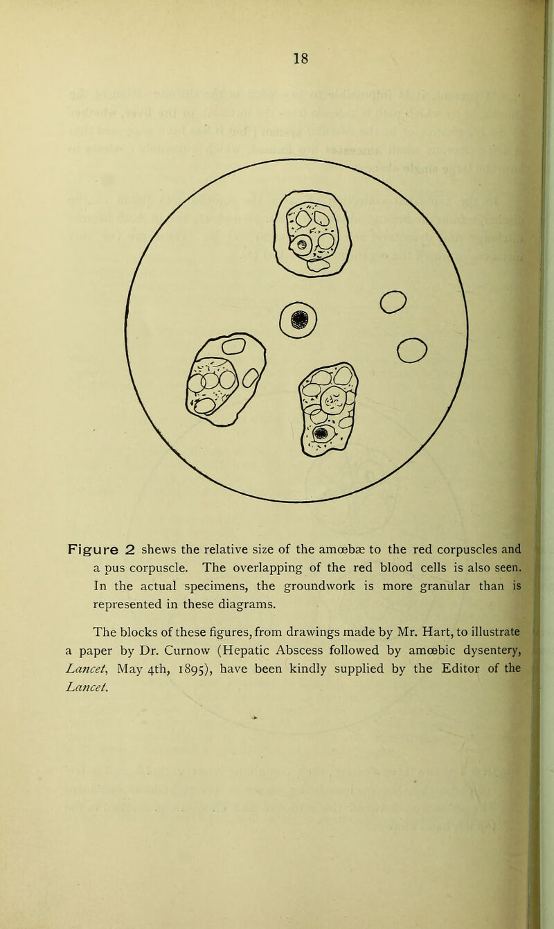 Figure 2 shews the relative size of the amoebce to the red corpuscles and a pus corpuscle. The overlapping of the red blood cells is also seen. In the actual specimens, the groundwork is more granular than is represented in these diagrams. The blocks of these figures, from drawings made by Mr. Hart, to illustrate a paper by Dr. Curnow (Hepatic Abscess followed by amoebic dysentery, Lancet^ May 4th, 1895), have been kindly supplied by the Editor of the Lancet.