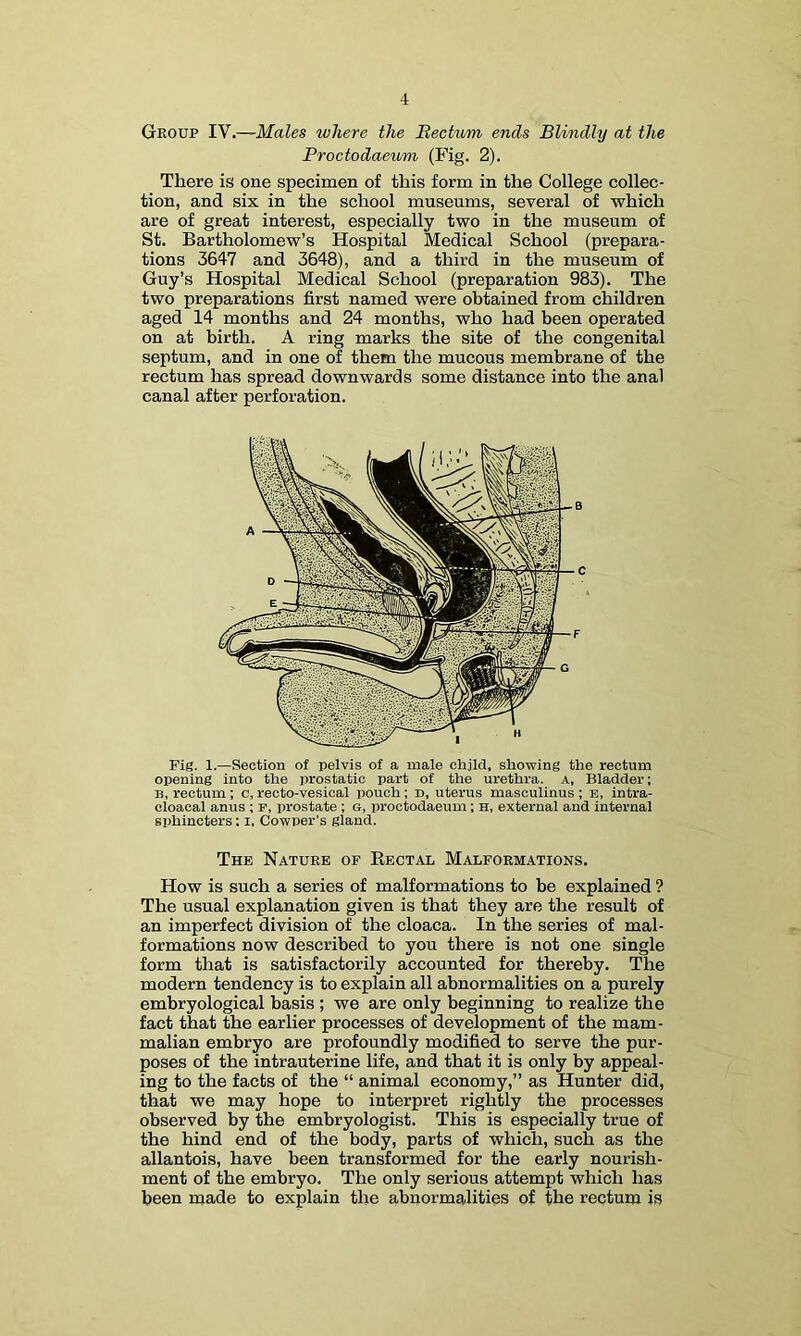 Group IV.—Males where the Rectum ends Blindly at the Proctodaeum (Fig. 2). There is one specimen of this form in the College collec- tion, and six in the school museums, several of which are of great interest, especially two in the museum of St. Bartholomew’s Hospital Medical School (prepara- tions 3647 and 3648), and a third in the museum of Guy’s Hospital Medical School (preparation 983). The two preparations first named were obtained from children aged 14 months and 24 months, who had been operated on at birth. A ring marks the site of the congenital septum, and in one of them the mucous membrane of the rectum has spread downwards some distance into the anal canal after perforation. Fig. 1.—Section of pelvis of a male child, showing the rectum opening into the prostatic part of the urethra, a. Bladder: B, rectum ; c, recto-vesical pouch ; d, uterus masoulinus ; b, intra- cloacal anus ; p, prostate; g, iiroctodaeum; H, external and internal sphincters: i, Cowper's gland. The Nature of Bectal Malformations. How is such a series of malformations to be explained ? The usual explanation given is that they are the result of an imperfect division of the cloaca. In the series of mal- formations now described to you there is not one single form that is satisfactorily accounted for thereby. The modern tendency is to explain all abnormalities on a purely embryological basis ; we are only beginning to realize the fact that the earlier processes of development of the mam- malian embryo are profoundly modified to serve the pur- poses of the intrauterine life, and that it is only by appeal- ing to the facts of the “ animal economy,” as Hunter did, that we may hope to interpret rightly the processes observed by the embryologist. This is especially true of the hind end of the body, parts of which, such as the allantois, have been transformed for the early nourish- ment of the embryo. The only serious attempt which has been made to explain the abnormalities of the rectum is