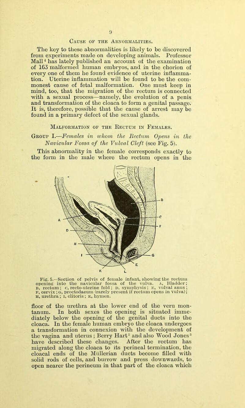 f) Cause of the Abnormalities. The key to these abnormalities is likely to be discovered from experiments made on developing animals. Professor Mall ^ has lately published an account of the examination of 163 malformed human embryos, and in the chorion of every one of them he found evidence of uterine inflamma- tion. Uterine inflammation will be found to be the com- monest cause of fetal malformation. One must keep in mind, too, that the migration of the rectum is connected with a sexual process—namely, the evolution of a penis and transformation of the cloaca to form a genital passage. It is, therefore, possible that the cause of arrest may be found in a primary defect of the sexual glands. Malformation of the Eectdm in Females. Group I.—Females in whoin the Rectum Oj^ens in the Navicular Fossa of the Vulval Cleft (see Fig. 5). This abnormality in the female corresponds exactly to the form in the male where the rectum opens in the Fig. 5.—Section of pelvis of female infant, showing the rectum opening into the navicular fossa of the vulva. A, Bladder; B, rectum; c, recto-uterine fold; d, symphysis; E, vulval anus ; E, cervix; g, proctodaeum (rarely present if rectum opens in vulva); H, urethra; i, clitoris; k, hymen. floor of the urethra at the lower end of the veru mon- tanum. In both sexes the opening is situated imme- diately below the opening of the genital ducts into the cloaca. In the female human embryo the cloaca undergoes a transformation in connexion with the development of the vagina and uterus ; Berry Hart® and also Wood Jones® have described these changes. After the rectum has migrated along the cloaca to its perineal termination, the cloacal ends of the Mullerian ducts become filled with solid rods of cells, and burrow and press downwards, to open nearer the perineum in that part of the cloaca which K L