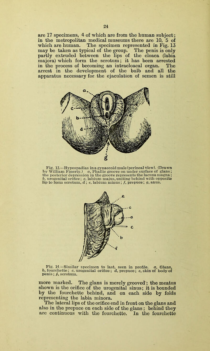 are 17 specimens, 4 of which are from the human subject; in the metropolitan medical museums there are 10, 5 of which are human. The specimen represented in Fig. 13 may be taken as typical of the group. The penis is only partly extruded between the lips of the cloaca (labia majora) which form the scrotum; it has been arrested in the process of becoming an intracloacal organ. The arrest in the development of the bulb and all the apparatus necessary for the ejaculation of semen is still Fig. 13.—Hypospadias in a gynaecoid male (perineal view). (Drawn by William Finerty.) a. Phallic groove on under surface of glans ; the posterior depression in the groove represents the lacuna magna; fc, urogenital orifice; c, labium majus,uniting behind with opposite lip to form scrotum, d; e, labium minus; /, prepuce; g, anus. Fig. 14.—Similar specimen to last, seen in profile, g, Gians, b, fourchette; c, urogenital orifice; d, prepuce; e, skin of body of penis; /, scrotum. more marked. The glans is merely grooved'; the meatus shown is the orifice of the urogenital sinus; it is bounded by the fourchette behind, and on each side by folds representing the labia minora. The lateral lips of the orifice end in front on the glans and also in the prepuce on each side of the glans ; behind they are continuous with the fourchette. In the fourchette