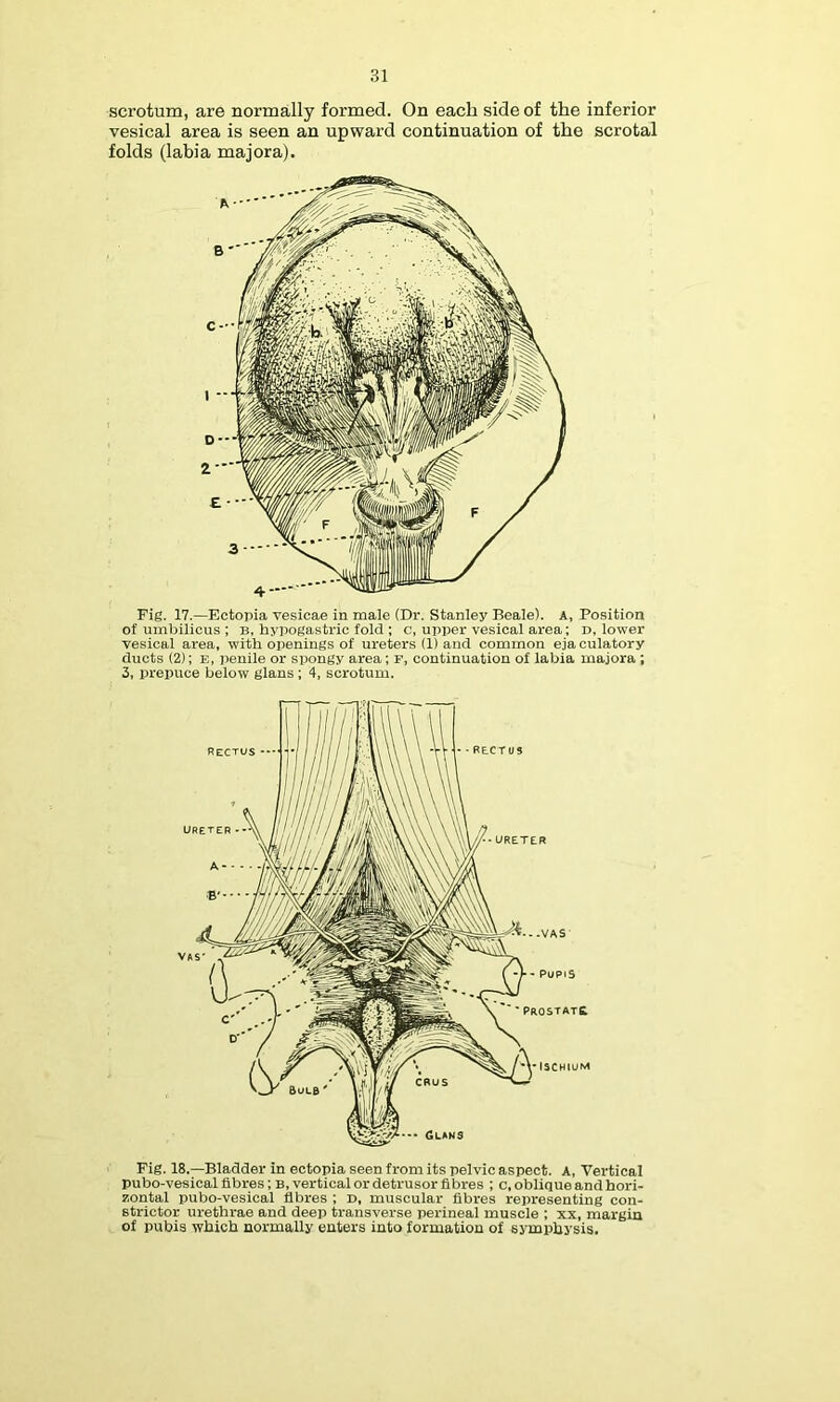 scrotum, are normally formed. On each side of the inferior vesical area is seen an upward continuation of the scrotal folds (labia majora). Fig. 17.—Ectopia vesicae in male (Dr. Stanley Beale). A, Position of umbilicus ; B, hypogastric fold ; c, upper vesical ai'ea; D, lower vesical area, with openings of ureters (1) and common eja culatory ducts (2); B, iienile or spongy area; F, continuation of labia majora ; 3, prepuce below glans ; 4, scrotum. zontal pubo-vesical fibres ; D, muscular fibres representing con- strictor urethrae and deep transverse perineal muscle ; xx, margin of pubis which normally enters into formation of symphysis.