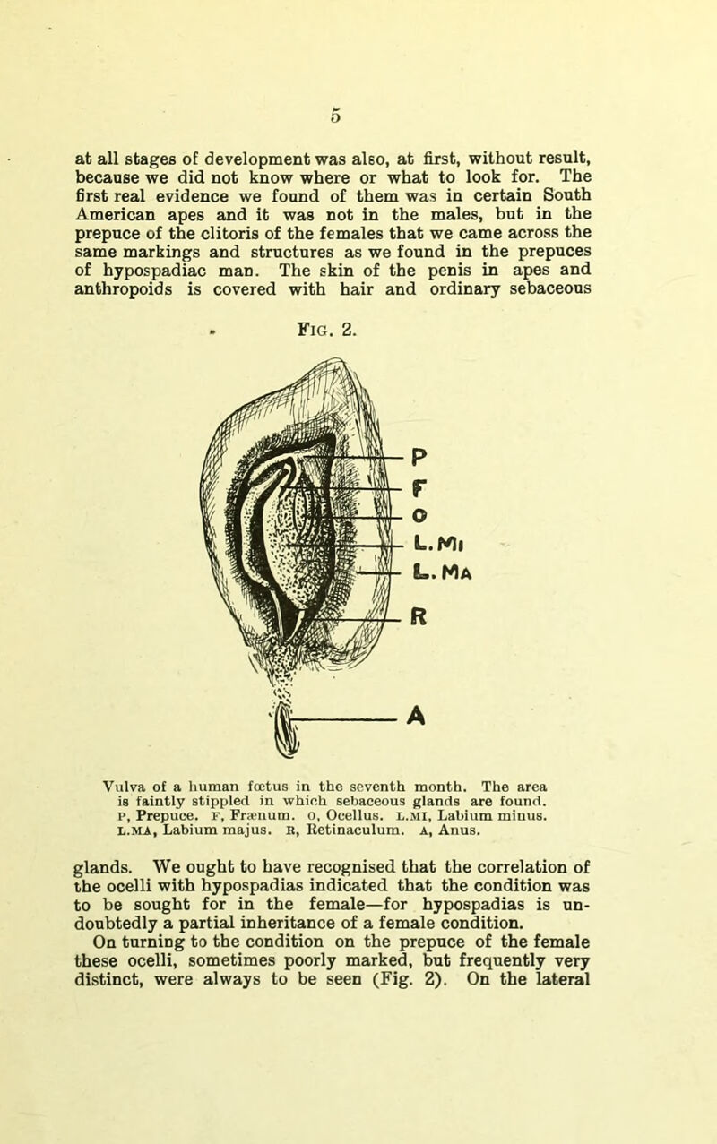 at all stages of development was also, at first, without result, because we did not know where or what to look for. The first real evidence we found of them was in certain South American apes and it was not in the males, but in the prepuce of the clitoris of the females that we came across the same markings and structures as we found in the prepuces of hypospadiac man. The skin of the penis in apes and anthropoids is covered with hair and ordinary sebaceous . Fig. 2. Vulva of a human foetus in the seventh month. The area is faintly stippled in whieh sebaceous glands are found, p, Prepuce, r, Fra'num. o, Ocellus, l.mi, Labium minus. L.MA, Labium majus. R, Retinaculum. A, Anus. glands. We ought to have recognised that the correlation of the ocelli with hypospadias indicated that the condition was to be sought for in the female—for hypospadias is un- doubtedly a partial inheritance of a female condition. On turning to the condition on the prepuce of the female these ocelli, sometimes poorly marked, but frequently very distinct, were always to be seen (Fig. 2). On the lateral