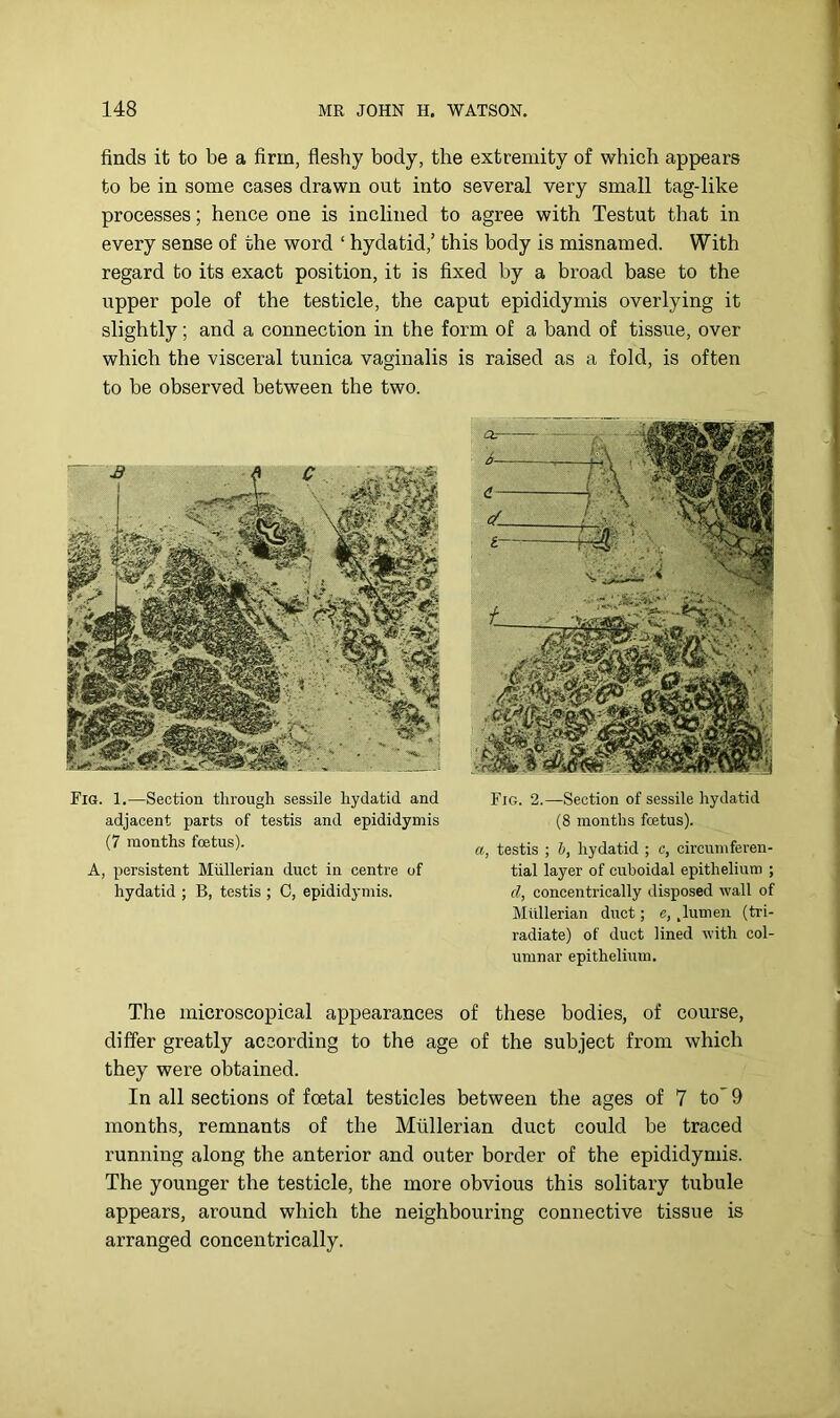 finds it to be a firm, fleshy body, the extremity of which appears to be in some cases drawn out into several very small tag-like processes; hence one is inclined to agree with Testut that in every sense of the word ‘ hydatid,’ this body is misnamed. With regard to its exact position, it is fixed by a broad base to the upper pole of the testicle, the caput epididymis overlying it slightly; and a connection in the form of a band of tissue, over which the visceral tunica vaginalis is raised as a fold, is often to be observed between the two. Fig. 1.—Section through sessile hydatid and adjacent parts of testis and epididymis (7 months foetus). A, persistent Mullerian duct in centre of hydatid ; B, testis ; 0, epididymis. Fig. 2.—Section of sessile hydatid (8 months foetus). a, testis ; b, hydatid ; c, circumferen- tial layer of cuboidal epithelium ; d, concentrically disposed wall of Mullerian duct; e, ,lumen (tri- radiate) of duct lined with col- umnar epithelium. The microscopical appearances of these bodies, of course, differ greatly according to the age of the subject from which they were obtained. In all sections of foetal testicles between the ages of 7 to’9 months, remnants of the Miillerian duct could be traced running along the anterior and outer border of the epididymis. The younger the testicle, the more obvious this solitary tubule appears, around which the neighbouring connective tissue is arranged concentrically.