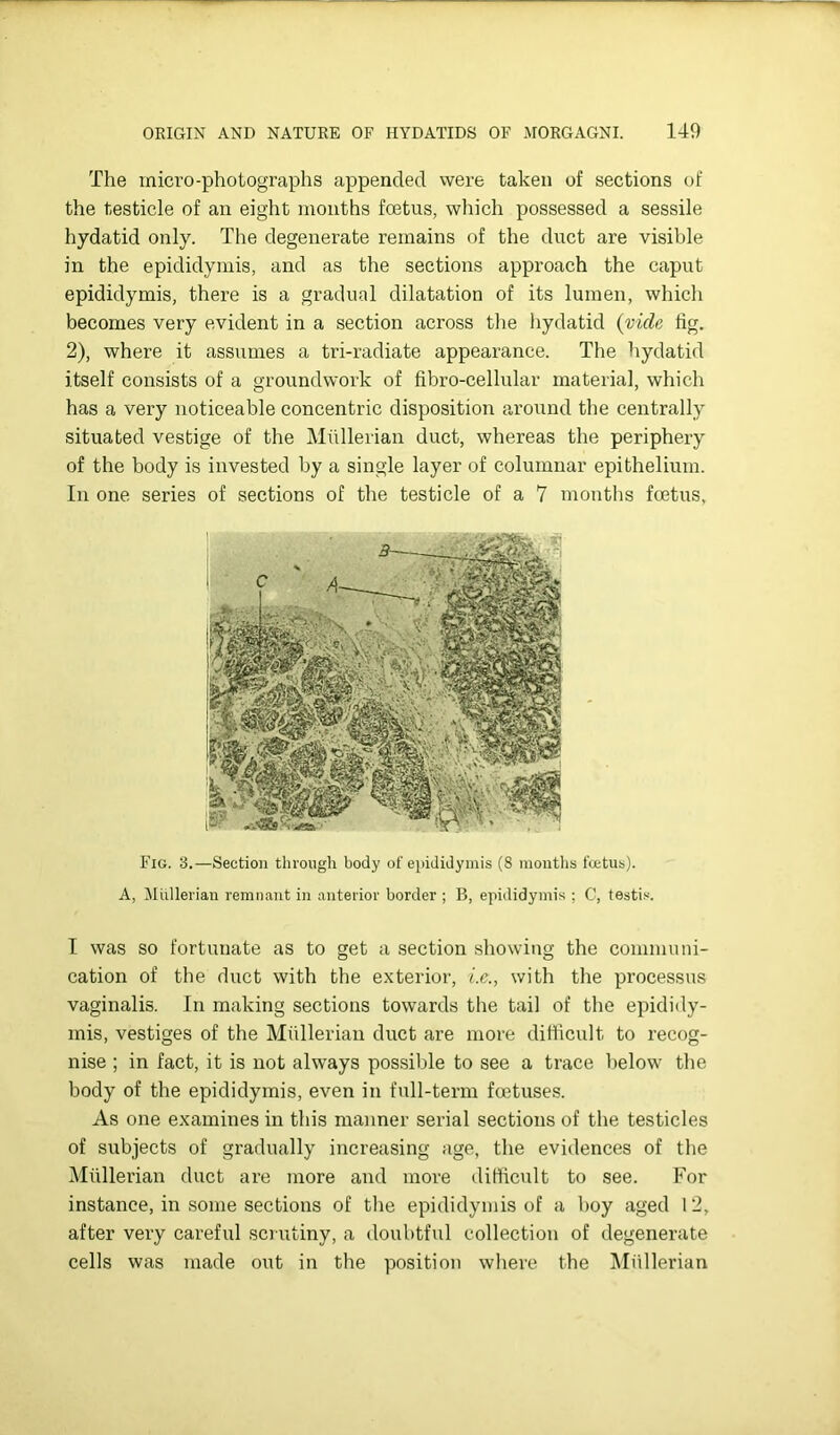 The micro-photographs appended were taken of sections of the testicle of an eight months foetus, which possessed a sessile hydatid only. The degenerate remains of the duct are visible in the epididymis, and as the sections approach the caput epididymis, there is a gradual dilatation of its lumen, which becomes very evident in a section across the hydatid (vide lig. 2), where it assumes a tri-radiate appearance. The hydatid itself consists of a groundwork of fibro-cellular material, which has a very noticeable concentric disposition around the centrally situated vestige of the Miillerian duct, whereas the periphery of the body is invested by a single layer of columnar epithelium. In one series of sections of the testicle of a 7 months foetus. Fig. 3.—Section through body of epididymis (8 montlis foetus). A, iliillerian remnant in anterior border ; B, epididymis ; C, testis. T was SO fortunate as to get a section showing the communi- cation of the duct with the exterior, i.e., with the processus vaginalis. In making sections towards the tail of the epididy- mis, vestiges of the Mullerian duct are more difficult to recog- nise ; in fact, it is not always possible to see a trace below the body of the epididymis, even in full-term foetuses. As one examines in this manner serial sections of the testicles of subjects of gradually increasing age, the evidences of the Miillerian duct are more and more difficult to see. For instance, in some sections of the epididymis of a boy aged 12, after very careful scrutiny, a doubtful collection of degenerate cells was made out in the position where the IMiUlerian