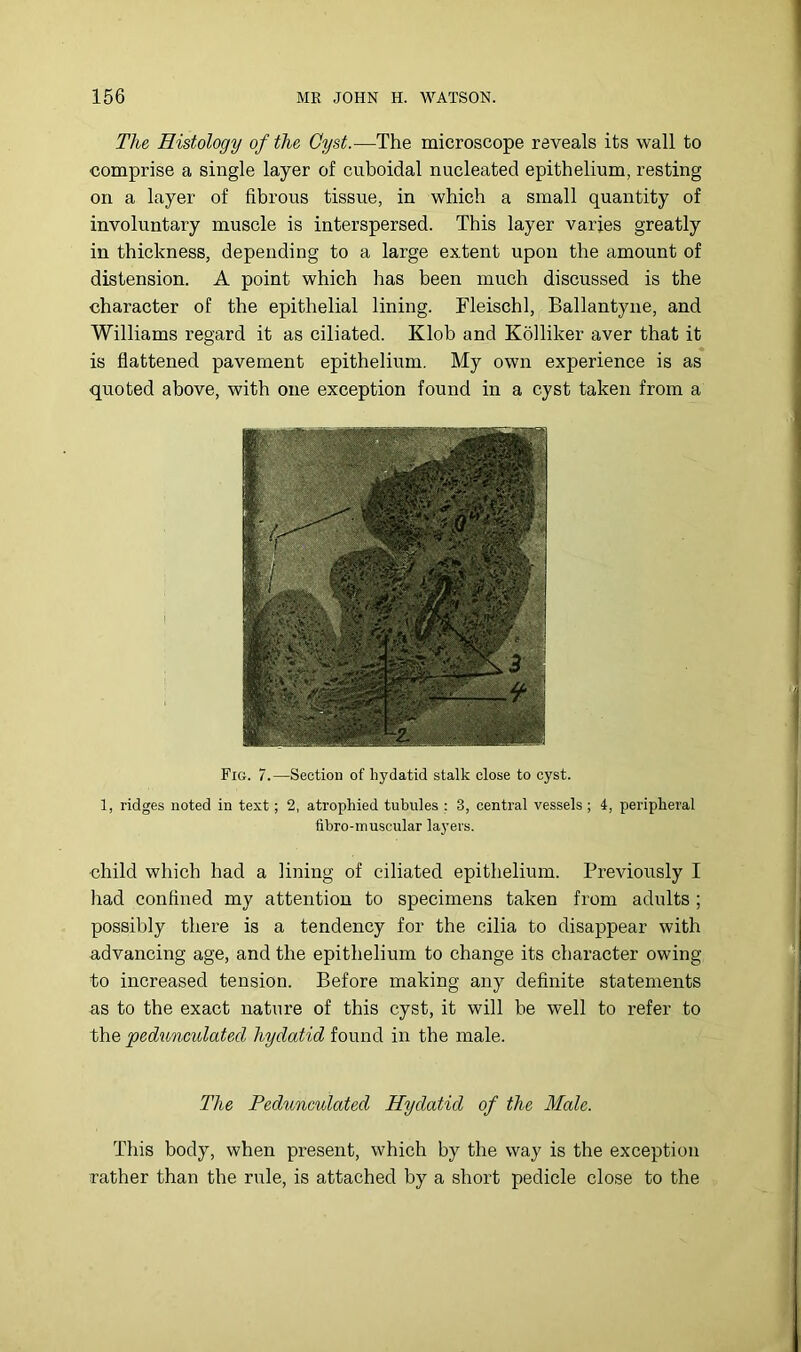 The Histology of the Cyst.—The microscope reveals its wall to comprise a single layer of cuboidal nucleated epithelium, resting on a layer of fibrous tissue, in which a small quantity of involuntary muscle is interspersed. This layer varies greatly in thickness, depending to a large extent upon the amount of distension. A point which has been much discussed is the character of the epithelial lining. Fleischl, Ballantyne, and Williams regard it as ciliated. Klob and Kolliker aver that it is flattened pavement epithelium. My own experience is as quoted above, with one exception found in a cyst taken from a Fig. 7.—Section of hydatid stalk close to cyst. 1, ridges noted in text; 2, atrophied tubules : 3, central vessels; 4, peripheral iibro-muscular layers. child which had a lining of ciliated epithelium. Previously I had confined my attention to specimens taken from adults ; possibly there is a tendency for the cilia to disappear with advancing age, and the epithelium to change its character owing to increased tension. Before making any definite statements as to the exact nature of this cyst, it will be well to refer to the pedioncidatecl hydatid found in the male. The Pedunculated Hydatid of the Male. This body, when present, which by the way is the exception rather than the rule, is attached by a short pedicle close to the