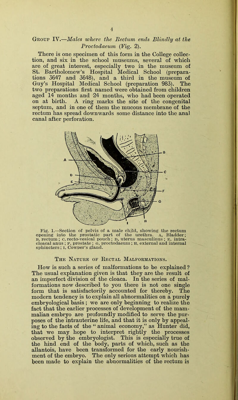 Group IV.—Males where the Bectum ends Blindly at the Proctodaeum (Fig. 2). There is one specimen of this form in the College collec- tion, and six in the school museums, several of which are of great interest, especially two in the museum of St. Bartholomew’s Hospital Medical School (prepara- tions 3647 and 3648), and a third in the museum of Guy’s Hospital Medical School (preparation 983). The two preparations first named were obtained from children aged 14 months and 24 months, who had been operated on at birth. A ring marks the site of the congenital septum, and in one of them the mucous membrane of the rectum has spread downwards some distance into the anal canal after perforation. Fig. 1.—Section of pelvis of a male child, showing the rectum opening into the prostatic part of the urethra. A, Bladder; B, rectum ; c, recto-vesical pouch; d, uterus masculinus ; e, intra- cloacal anus ; p, prostate; G, proctodaeum; H, external and internal sphincters; i, Cowper’s gland. The Nature op Eectal Malformations. How is such a series of malformations to be explained ? The usual explanation given is that they are the result of an imperfect division of the cloaca. In the series of mal- formations now described to you there is not one single form that is satisfactorily accounted for thereby. The modern tendency is to explain all abnormalities on a purely embryological basis ; we are only beginning to realize the fact that the earlier processes of development of the mam- malian embryo are profoundly modified to serve the pur- poses of the iptrauterine life, and that it is only by appeal- ing to the facts of the “ animal economy,” as Hunter did, that we may hope to interpret rightly the processes observed by the embryologist. This is especially true of the hind end of the body, parts of which, such as the allantois, have been transformed for the early nourish- ment of the embryo. The only serious attempt which has been made to explain the abnormalities of the rectum is