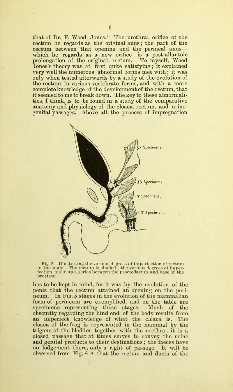 rectum he regards as the original anus; the part of the rectum between that opening and the perineal anus— which he regards as a new orifice—is a post-allantoic prolongation of the original rectum. To myself, Wood Jones’s theory was at first quite satisfying ; it explained very well the numerous abnormal forms met with; it was only when tested afterwards by a study of the evolution of the rectum in various vertebrate forms, and with a more complete knowledge of the development of the rectum, that it seemed to me to break down. The key to these abnormali- ties, I think, is to be found in a study of the comparative anatomy and physiology of the cloaca, rectum, and urino- genital passages. Above all, the process of impregnation Fig. 2.—Illustrating the various dsgrees of imperfection of rectum in the male. The rectum is shaded ; the various degrees of imper- fection make up a series between the proctodaeum and base of the prostate. has to be kept in mind, for it was by the evolution of the penis that the rectum attained an opening on the peri- neum. In Fig. 3 stages in the evolution of the mammalian form of perineum are exemplified, and on the table are specimens representing those stages. Much of the obscurity regarding the hind end of the body results from an imperfect knowledge of what the cloaca is. The cloaca of the frog is represented in the mammal by the trigone of the bladder together with the urethra: it is a closed passage that at times serves to convey the urine and genital products to their destinations; the faeces have no lodgement there, only a right of passage. It will be