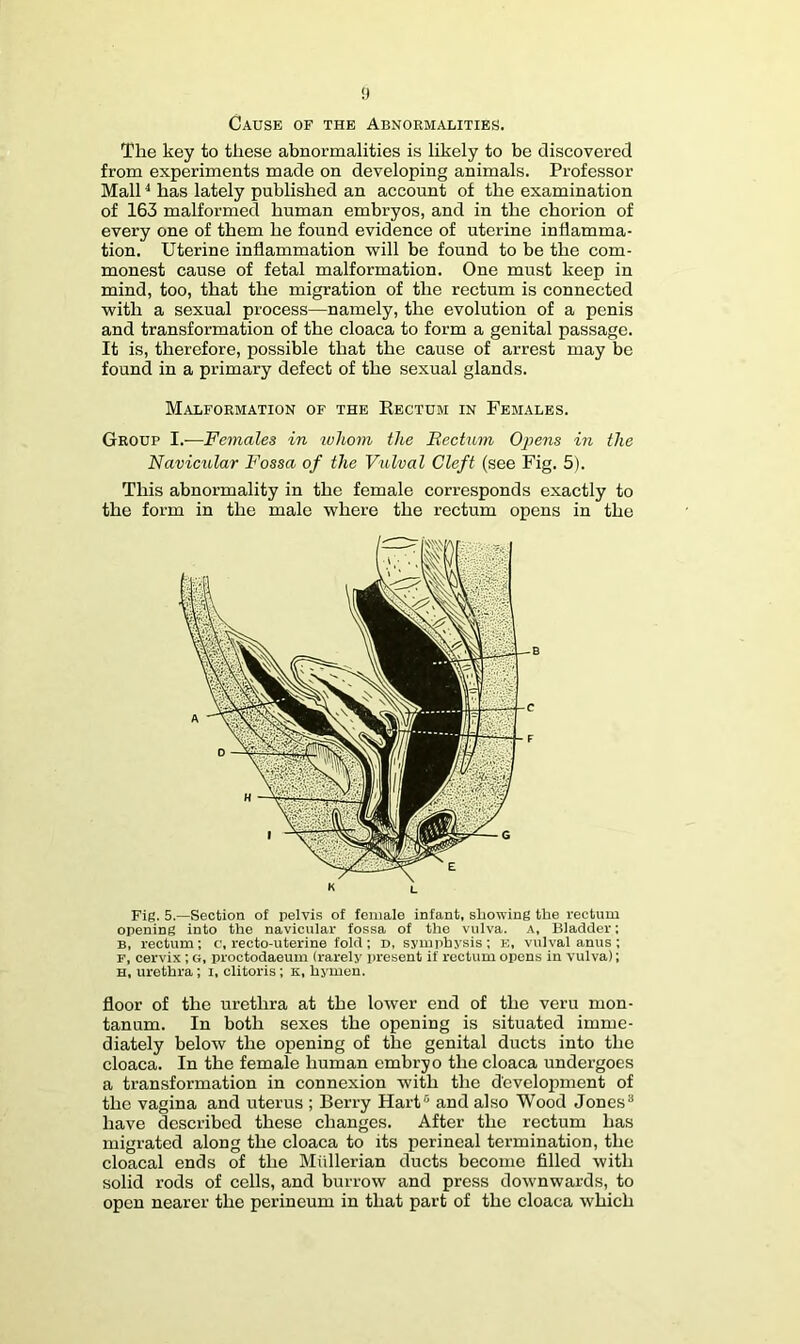 Cause of the Abnormalities. The key to these abnormalities is likely to be discovered from experiments made on developing animals. Professor Mall ^ has lately published an account of the examination of 163 malformed human embryos, and in the chorion of every one of them he found evidence of uterine inflamma- tion. Uterine inflammation will be found to be the com- monest cause of fetal malformation. One must keep in mind, too, that the migration of the rectum is connected with a sexual process—namely, the evolution of a penis and transformation of the cloaca to form a genital passage. It is, therefore, possible that the cause of arrest may be found in a primary defect of the sexual glands. Malformation of the Rectum in Females. Group I.—Females in luhoin the Rectum Opens in the Navicular Fossa of the Vulval Cleft (see Fig. 5). This abnormality in the female corresponds exactly to the form in the male where the rectum opens in the K L Fig. 5.—Section of pelvis of female infant, showing the rectum opening into the navicular fossa of the vulva. A, Bladder; B, rectum; c, recto-uterine fold; d, symphysis; e, vulval anus ; F, cervix; g, proctodaeum (rarely present if rectum opens in vulva); H, urethra; i, clitoris; k, hymen. floor of the urethra at the lower end of the veru mon- tanum. In both sexes the opening is situated imme- diately below the opening of the genital ducts into the cloaca. In the female human embryo the cloaca undergoes a transformation in connexion with the development of the vagina and uterus ; Berry Hart® and also Wood Jones® have described these changes. After the rectum has migrated along the cloaca to its perineal termination, the cloacal ends of the Miillerian ducts become filled with solid rods of cells, and burrow and press downwards, to open nearer the perineum in that part of the cloaca which