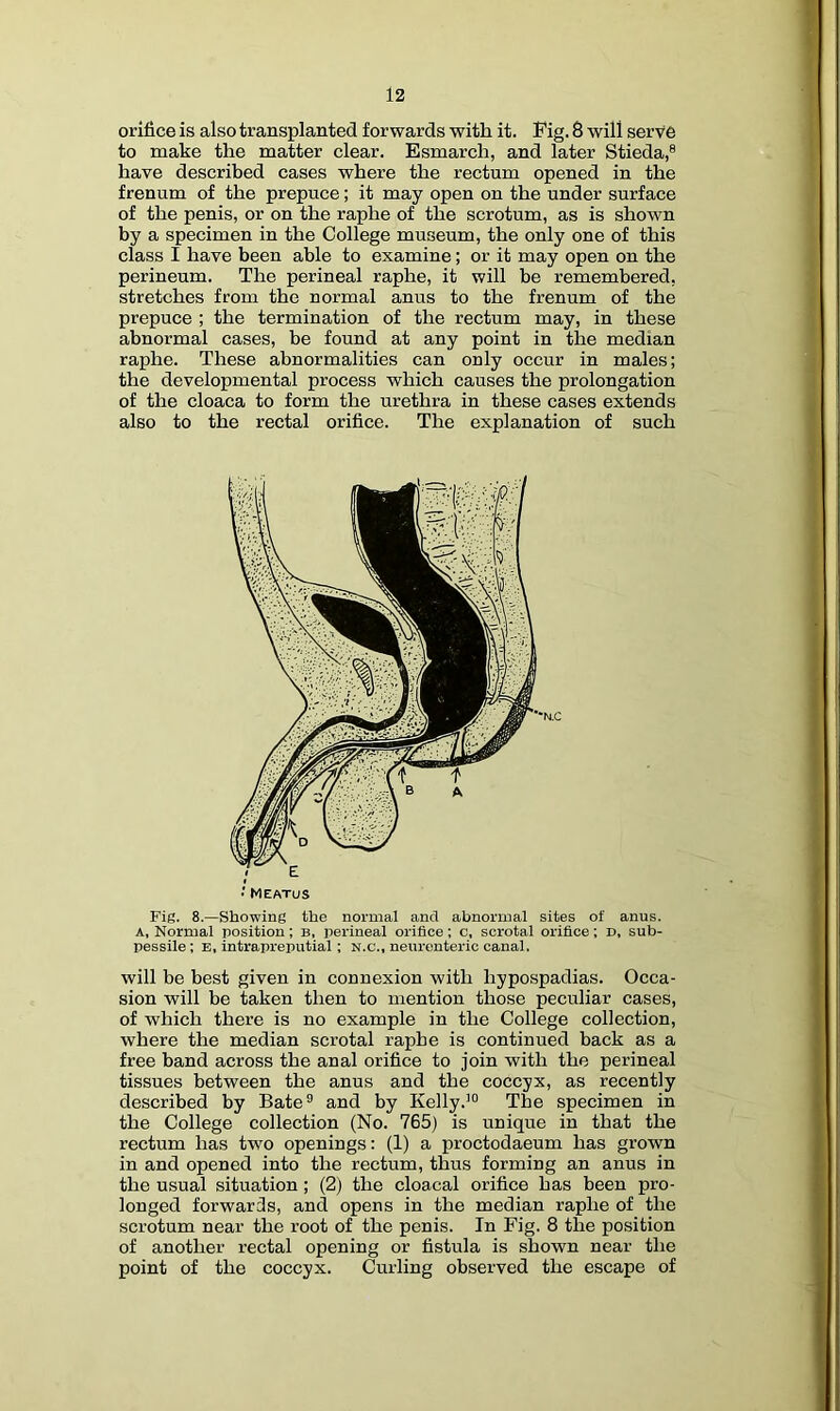 orifice is also transplanted forwards with it. Pig. 8 will serve to make the matter clear. Esmarch, and later Stieda,® have described cases where the rectum opened in the frenum of the prepuce; it may open on the under surface of the penis, or on the raphe of the scrotum, as is shown by a specimen in the College museum, the only one of this class I have been able to examine; or it may open on the perineum. The perineal raphe, it will he remembered, stretches from the normal anus to the frenum of the prepuce ; the termination of the rectum may, in these abnormal cases, be found at any point in the median raphe. These abnormalities can only occur in males; the developmental process which causes the prolongation of the cloaca to form the urethra in these cases extends also to the rectal orifice. The explanation of such Fig. 8.—Showing the normal and abnormal sites of anus. A, Normal position; B, perineal orifice; c, scrotal orifice; D, sub- pessile : e, intrapreputial ; n.c., neurenteric canal. will be best given in connexion with hypospadias. Occa- sion will be taken then to mention those peculiar cases, of which there is no example in the College collection, where the median scrotal raphe is continued back as a free band across the anal orifice to join with the perineal tissues between the anus and the coccyx, as recently described by Bate® and by Kelly.’® The specimen in the College collection (No. 765) is unique in that the rectum has two openings: (1) a proctodaeum has grown in and opened into the rectum, thus forming an anus in the usual situation; (2) the cloacal orifice has been pro- longed forwards, and opens in the median raphe of the scrotum near the root of the penis. In Fig. 8 the position of another rectal opening or fistula is shown near the point of the coccyx. Curling observed the escape of