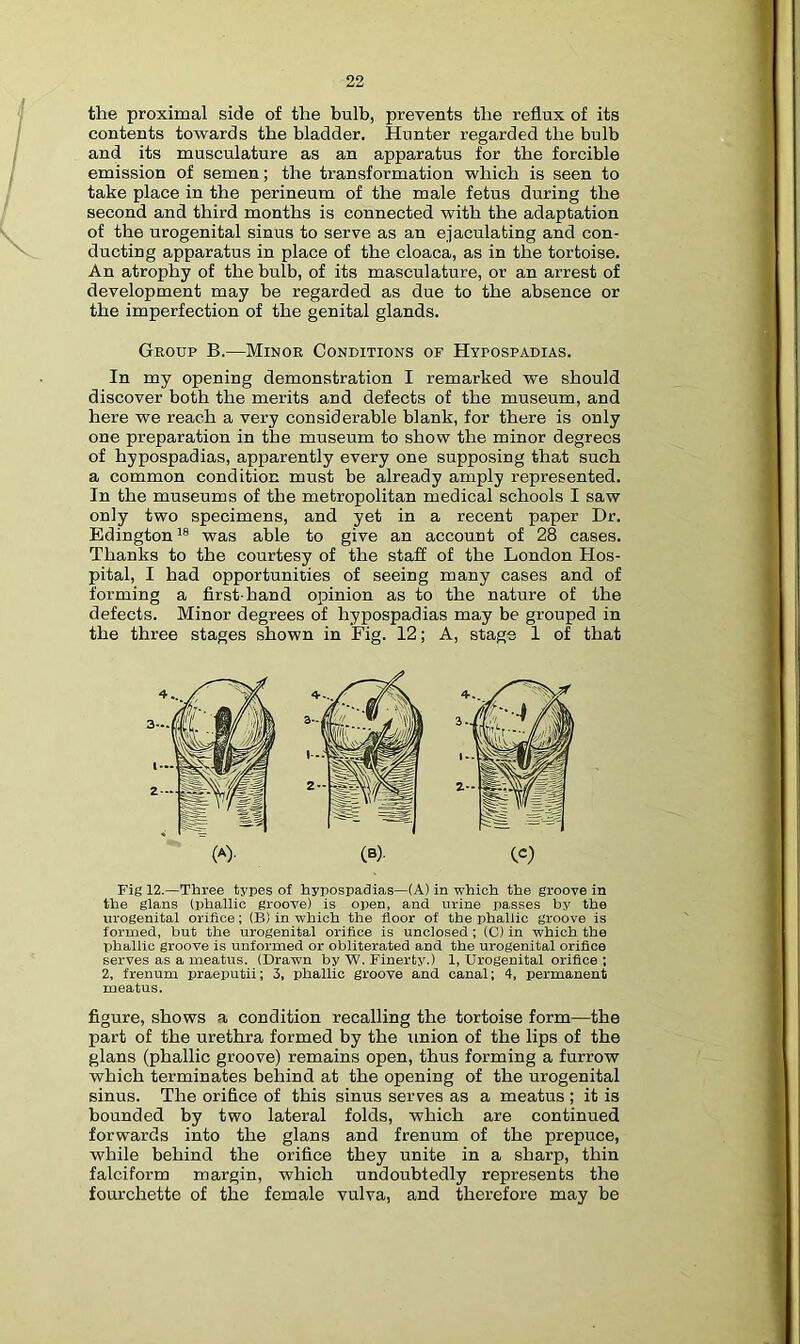 the proximal side of the bulb, prevents the reflux of its contents towards the bladder. Hunter regarded the bulb and its musculature as an apparatus for the forcible emission of semen; the transformation which is seen to take place in the perineum of the male fetus during the second and third months is connected with the adaptation of the urogenital sinus to serve as an ejaculating and con- ducting apparatus in place of the cloaca, as in the tortoise. An atrophy of the bulb, of its masculature, or an arrest of development may be regarded as due to the absence or the imperfection of the genital glands. Group B.—Minor Conditions of Hypospadias. In my opening demonstration I remarked we should discover both the merits and defects of the museum, and here we reach a very considerable blank, for there is only one preparation in the museum to show the minor degrees of hypospadias, apparently every one supposing that such a common condition must be already amply represented. In the museums of the metropolitan medical schools I saw only two specimens, and yet in a recent paper Dr. Edington’® was able to give an account of 28 cases. Thanks to the courtesy of the staff of the London Hos- pital, I had opportunities of seeing many cases and of forming a first-hand opinion as to the nature of the defects. Minor degrees of hypospadias may be grouped in the three stages shown in Fig. 12; A, stage 1 of that Fig 12.—Three types of hypospadias—(A) in ■which the groove in the glans (phallic groove) is open, and urine passes by the urogenital orifice; (B) in which the floor of the phallic groove is formed, but the urogenital orifice is unclosed; (C) in which the phallic groove is unformed or obliterated and the urogenital orifice serves as a meatus. (Drawn by W. Finerty.) 1, Urogenital orifice ; 2, frenum praeputii; 3, phallic groove and canal; 4, permanent meatus. figure, shows a condition recalling the tortoise form—the part of the urethra formed by the union of the lips of the glans (phallic groove) remains open, thus forming a furrow which terminates behind at the opening of the urogenital sinus. The orifice of this sinus serves as a meatus ; it is bounded by two lateral folds, which are continued forwards into the glans and frenum of the prepuce, while behind the orifice they unite in a sharp, thin falciform margin, which undoubtedly represents the fourchette of the female vulva, and therefore may be (A). (B)-