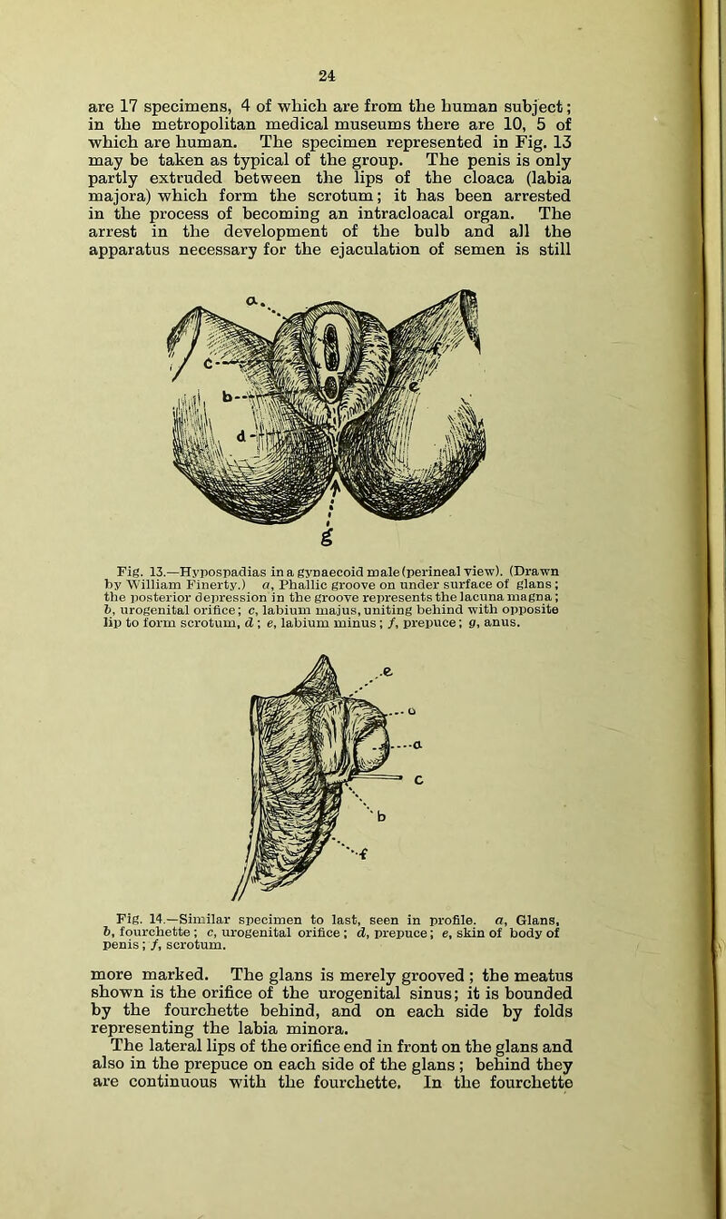 are 17 specimens, 4 of which are from the human subject; in the metropolitan medical museums there are 10, 5 of which are human. The specimen represented in Fig. 13 may be taken as typical of the group. The penis is only partly extruded between the lips of the cloaca (labia majora) which form the scrotum; it has been arrested in the process of becoming an intracloacal organ. The arrest in the development of the bulb and all the apparatus necessary for the ejaculation of semen is still Fig. 13.—Hypospadias in a gypaecoid male (perineal view). (Drawn by William Finerty.) a, Phallic groove on under surface of glans; the posterior depression in the groove represents the lacuna magna; b, urogenital orifice; c, labium majus,uniting behind with opposite lip to form scrotum, d; e, labium minus; /, prepuce; g, anus. Fig. 14.—Similar specimen to last, seen in profile, a, Gians, b, fourchette; c, urogenital orifice; d, prepuce; e, skin of body of penis; f, scrotum. more marked. The glans is merely grooved ; the meatus shown is the orifice of the urogenital sinus; it is bounded by the fourchette behind, and on each side by folds representing the labia minora. The lateral lips of the orifice end in front on the glans and also in the prepuce on each side of the glans; behind they are continuous with the fourchette. In the fourchette