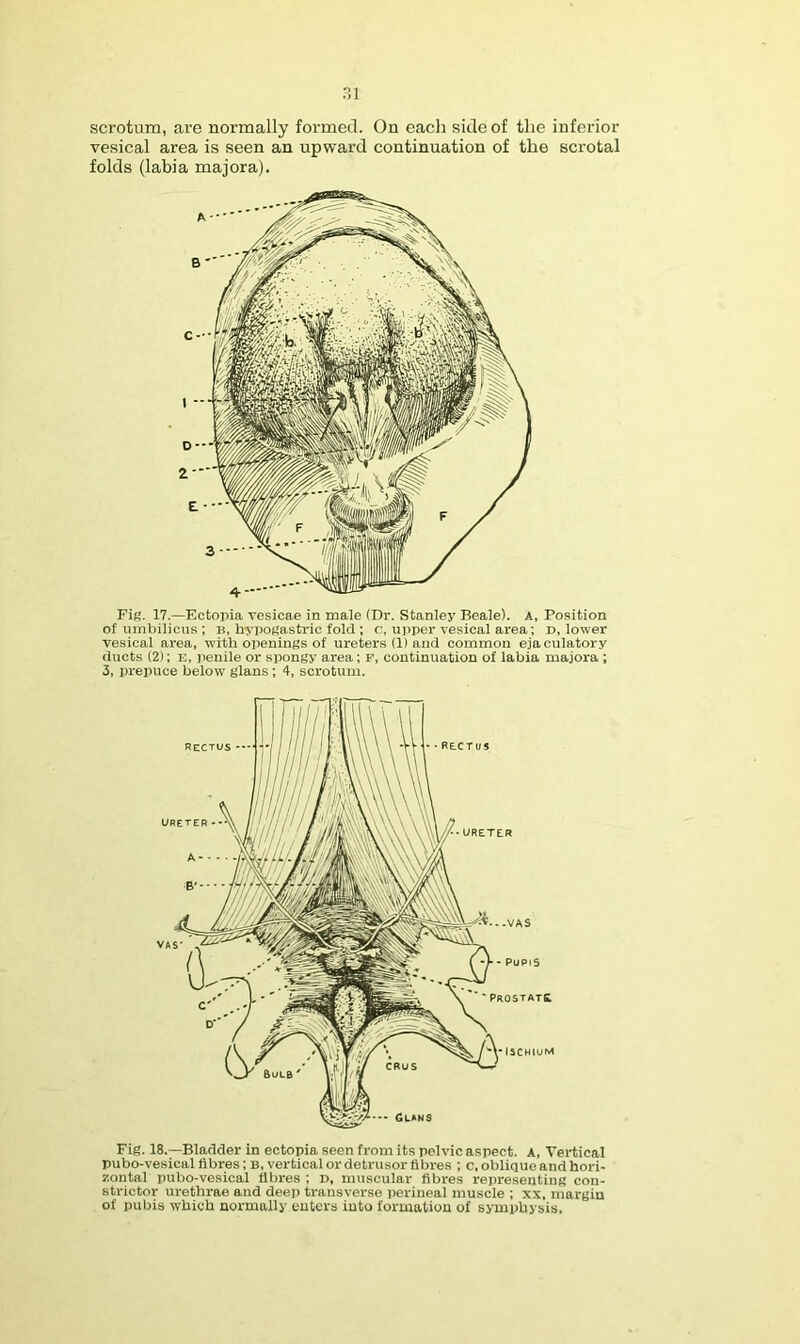 rii scrotum, are normally formed. On each side of the inferior vesical area is seen an npward continuation of the scrotal folds (labia majora). Fig. 17.—Ectopia vesioae in male (Dr. Stanley Beale). A, Position of umbilicus ; b, hypogastric fold ; c, upper vesical area; D, lower vesical area, with openings of ureters (1) and common eja culatory ducts (2); E, iienile or spongy area; F, continuation of labia majora ; 3, prepuce below glans ; 4, scrotum. Fig. 18.—Bladder in ectopia seen from its pelvic aspect. A, Vertical pubo-vesical fibres; B, vertical or detrusor fibres ; c, oblique and hori- zontal pubo-vesical fibres ; D, muscular fibres representing con- strictor urethi-ae and deej) transverse perineal muscle ; xs. margin of pubis which normally enters into formation of symphysis.