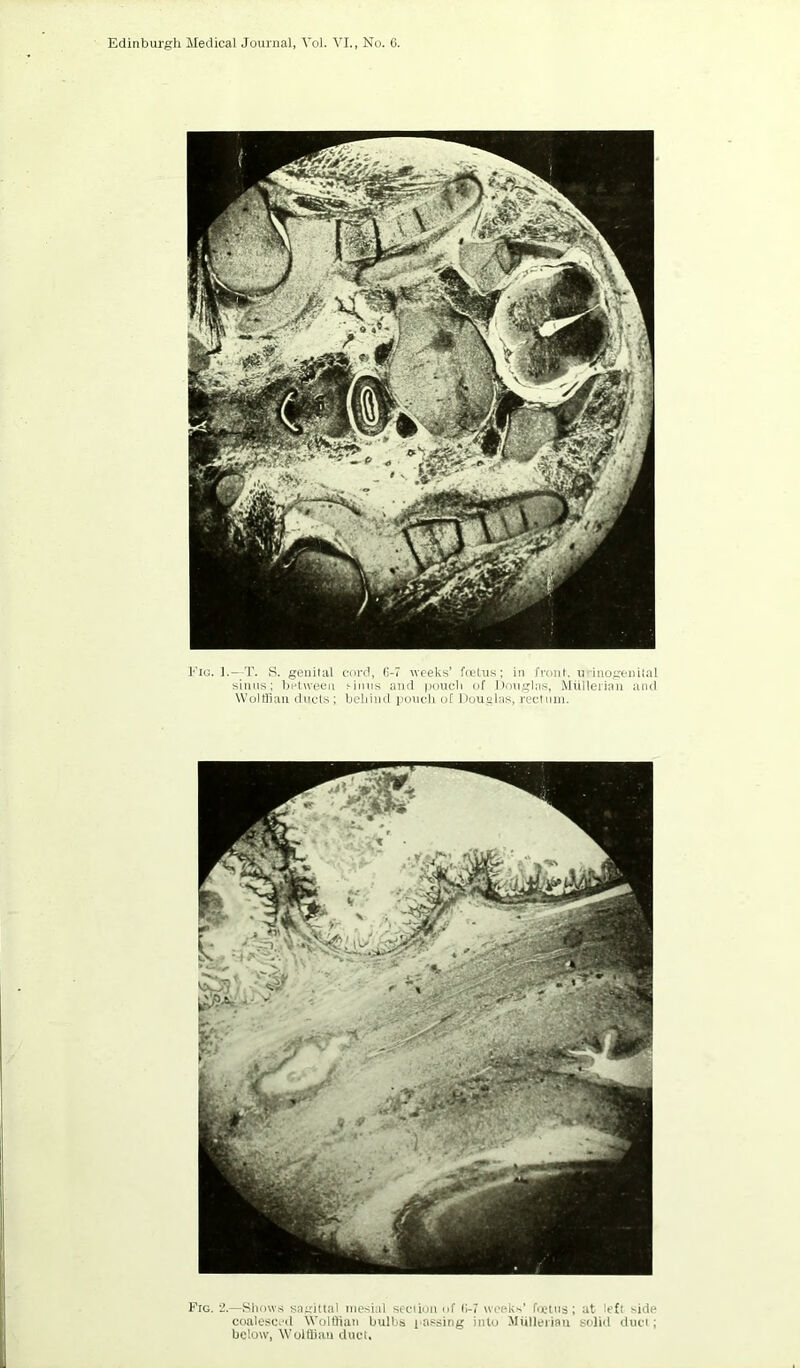 Fig. 1-—T- S. genUal cord, (;-7 weeks’ htlus; in fronl. u inogenital sinus; between einns and poucli of Dmigla.s, MUllerian and Woltlian duels; behind iionch of Douglas, rectiun. Fro. 2.—Shows sagittal mesial section of ll-f weeks’ foetus; at left side coaiesc.'d Volthan bulbs passing into Mtilleriau soiiii duct; below, Wolflian duct.