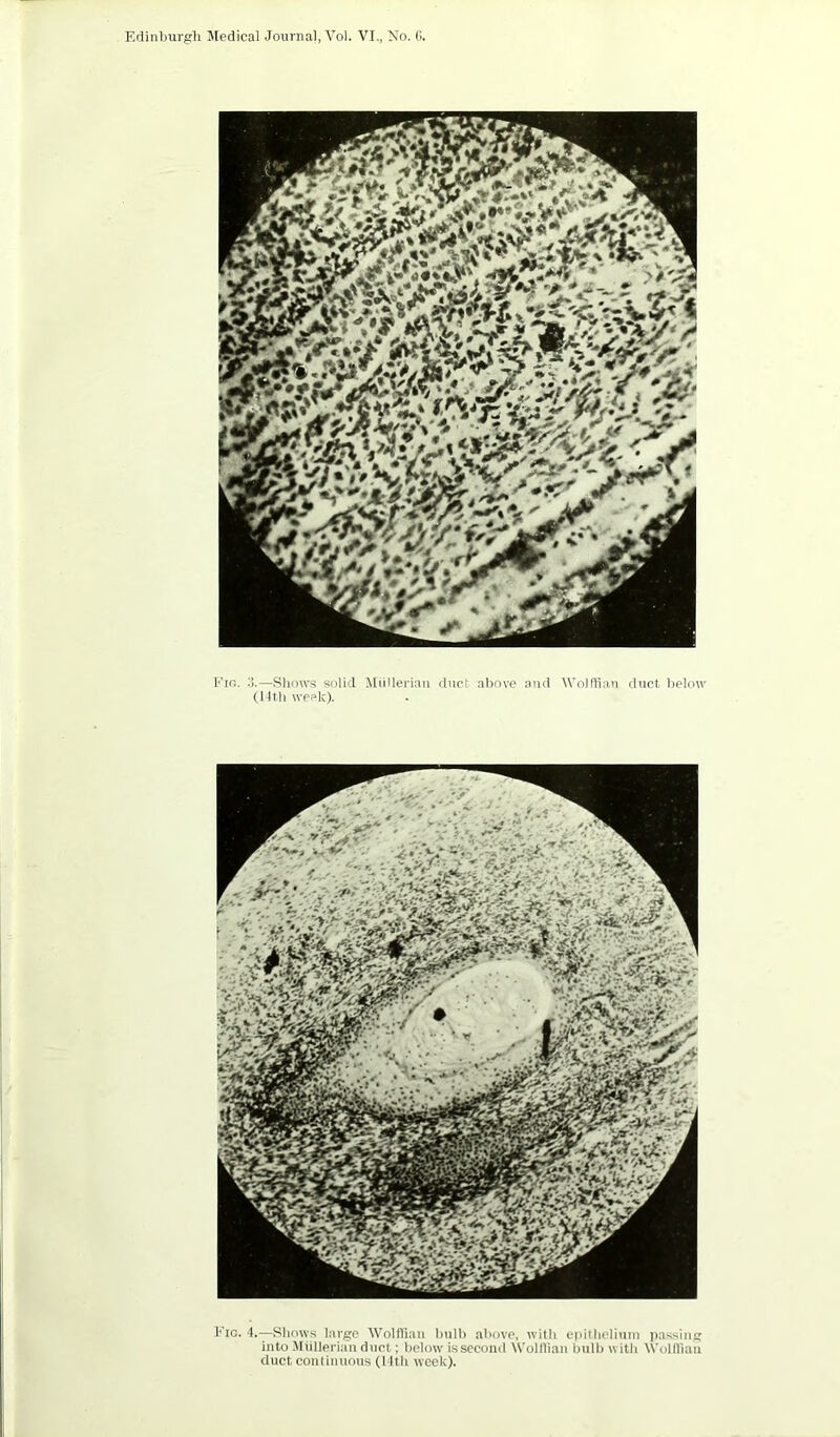 Eio. —Shows solid lliillerian duct al)ove and Wolffian duct below (llfli week). Etc. h—Sliows large Wolffian bulb above, with epiilielimn passing into .Miillerian duel ; below is second Wolllian Inilb «itb Wolffian duct conliiiuous (l ltb week).