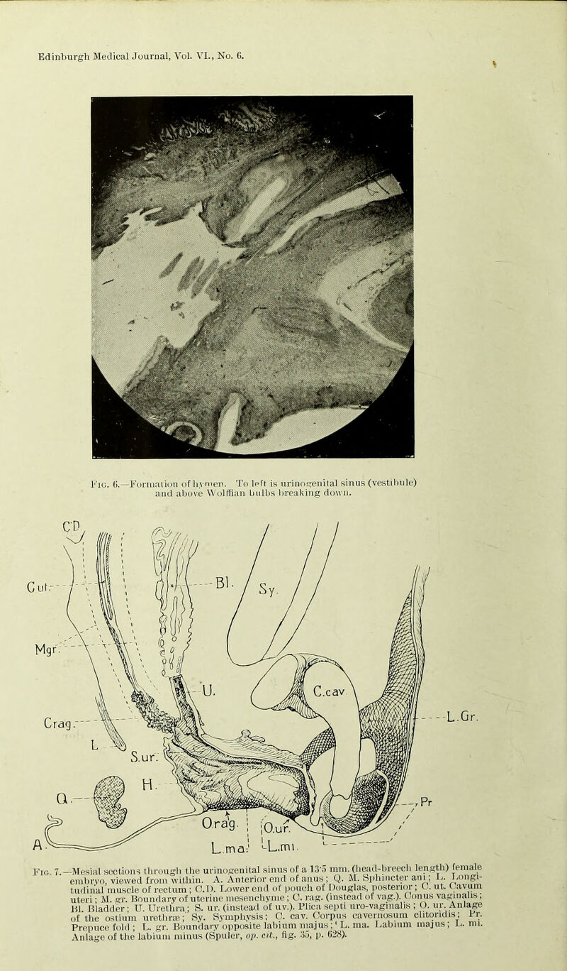 I’lG. ().—Formaiion ol'hvnien. To left is urinogeiiital sinus (vestilinle) and above WolHiau bulbs l)reakiug down. - -L.Gr. I'To. 7.—Mesial sections tiirougli tlie urinogenital sinus of a IS'o inra. (head-breech length) female embrvo, viewed from within. A. Anterior end of anus ; Q. M. Splnncter atii, L. longi- tudinal muscle of rectum ; C.D. Lower end of iimich of Ilouglas, jiostenor; G. ut. ( avum Uteri; M. ffi*. Houiidarv of uterine mesencliyme; O. ra^. (instead of vag.). Conus vaginalis, B1 Bladder • U. Urethra; S. ur. (instead of uv.). Plica septi uro-vagiiialis ; O. ur. Milage of the ostium uretline;' Ry. Rymiiliysis: O. cav. Corpus cavernosum clitoridis; Fr. Prepuce fold ; I., gr. Boundary opposite labium niajus L. ma. Labium nia,)us; L. mi. Anlage of the labium minus (Spider, op. cit., Ilg. 35, p. (>28).