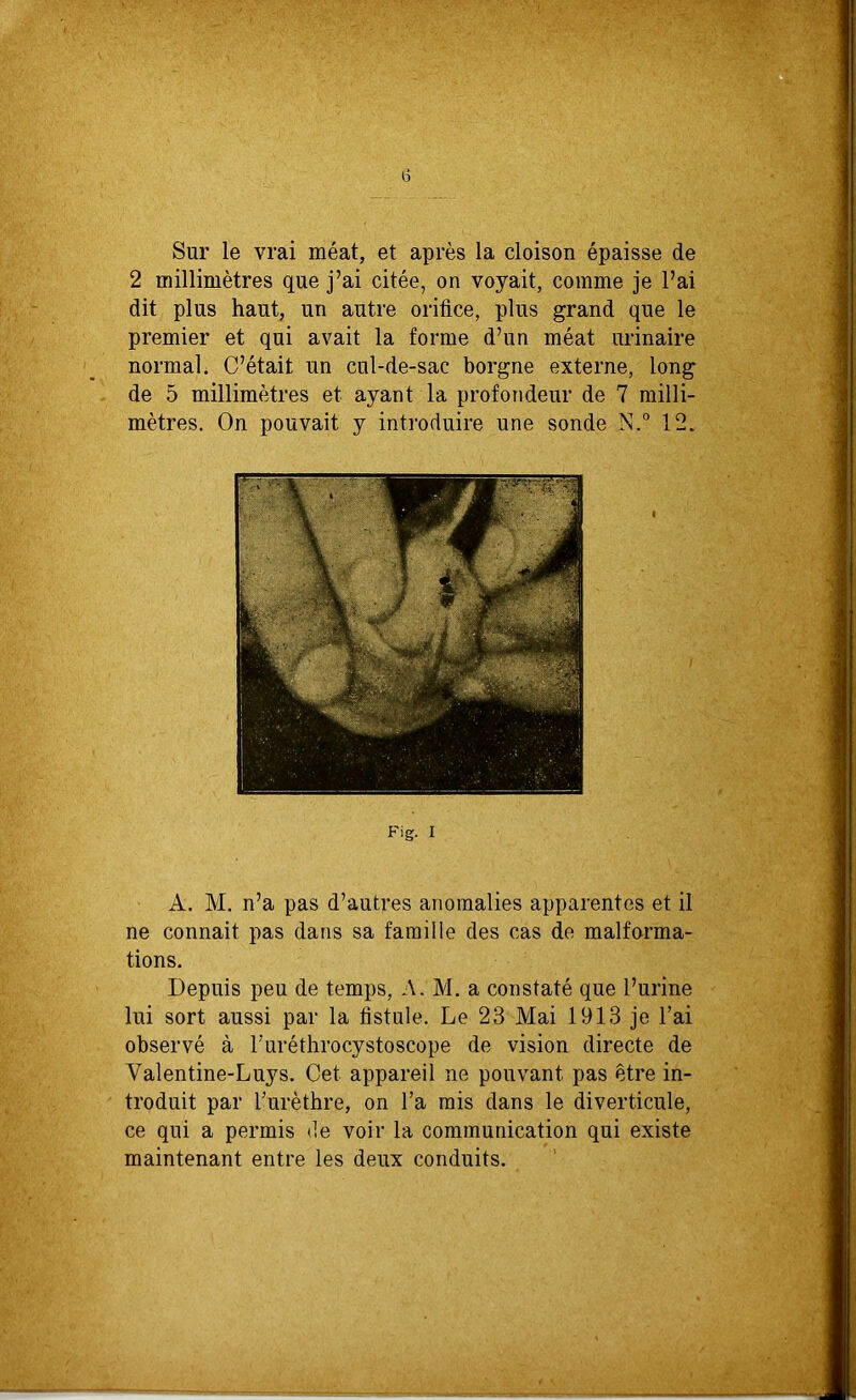 i5 Sur le vrai méat, et après la cloison épaisse de 2 millimètres que j’ai citée, on voyait, comme je l’ai dit plus haut, un autre orifice, plus grand que le premier et qui avait la forme d’un méat urinaire normal. C’était un cul-de-sac borgne externe, long de 5 millimètres et ayant la profondeur de 7 milli- mètres. On pouvait y introduire une sonde N.° 12. Fig. I A. M. n’a pas d’autres anomalies apparentes et il ne connait pas dans sa famille des cas de malforma- tions. Depuis peu de temps, A. M. a constaté que l’urine lui sort aussi par la fistule. Le 23 Mai 1913 je l’ai observé à l’uréthrocystoscope de vision directe de Valentine-Luys. Cet appareil ne pouvant pas être in- troduit par l’urèthre, on l’a mis dans le diverticule, ce qui a permis de voir la communication qui existe maintenant entre les deux conduits.