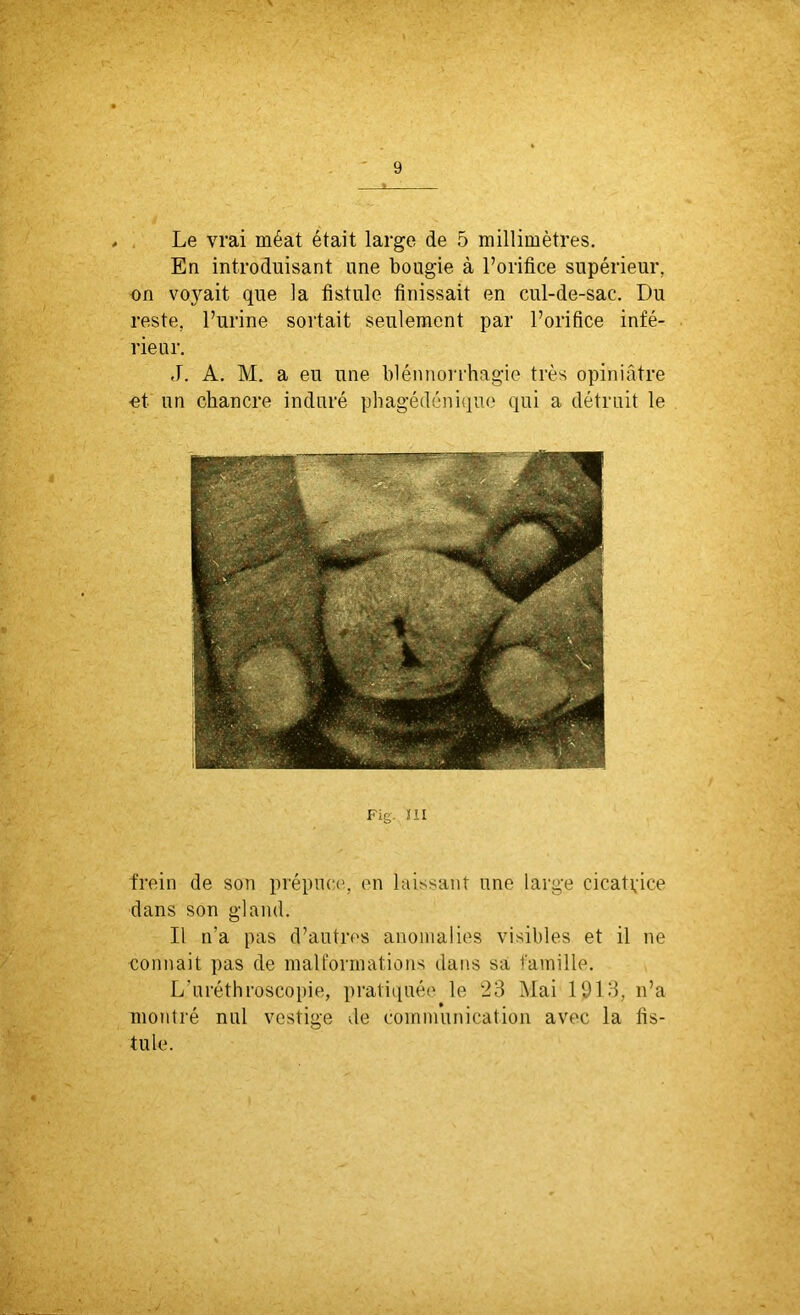 Le vrai méat était large de 5 millimètres. En introduisant une bougie à l’orifice supérieur, on voyait que la fistule finissait en cul-de-sac. Du reste, l’urine sortait seulement par l’orifice infé- rieur. J. A. M. a eu une blénnorrhagie très opiniâtre ■et un chancre induré phagédénique qui a détruit le Fig m frein de son prépuce, en laissant une large cicatrice dans son gland. Il n’a pas d’autres anomalies visibles et il ne connaît pas de malformations dans sa famille. L’uréthroscopie, pratiquée le 23 Mai 1913, n’a montré nul vestige de communication avec la fis- tule.