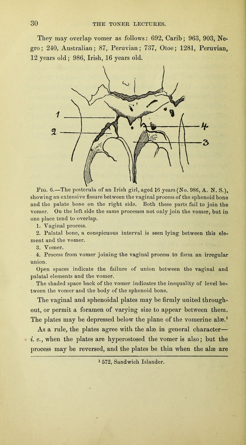 They may overlap vomer as follows; 692, Carib; 963, 903, Ne- gro ; 240, Australian ; 87, Peruvian; 737, Otoe; 1281, Peruvian, 12 years old; 986, Irish, 16 years old. showing an extensive fissure between the vaginal process of the sphenoid bone and the palate bone on the right side. Both these parts fail to join the vomer. On the left side the same processes not only join the vomer, but in one place tend to overlap. 1. Vaginal process. 2. Palatal bone, a conspicuous interval is seen lying between this ele- ment and the vomer. 3. Vomer. 4. Process from vomer joining the vaginal process to form an irregular union. Open spaces indicate the failure of union between the vaginal and palatal elements and the vomer. The shaded space back of the vomer indicates the inequality of level be- tween the vomer and the body of the sphenoid bone. The vaginal and sphenoidal plates may be firmly united through- out, or permit a foramen of varying size to appear between them. The plates may be depressed below the plane of the vomerine alae.^ As a rule, the plates agree with the alse in general character— i. e., when the plates are hyperostosed the vomer is also; but the process may be reversed, and the plates be thin when the alse are 1 572, Sandwich Islander.