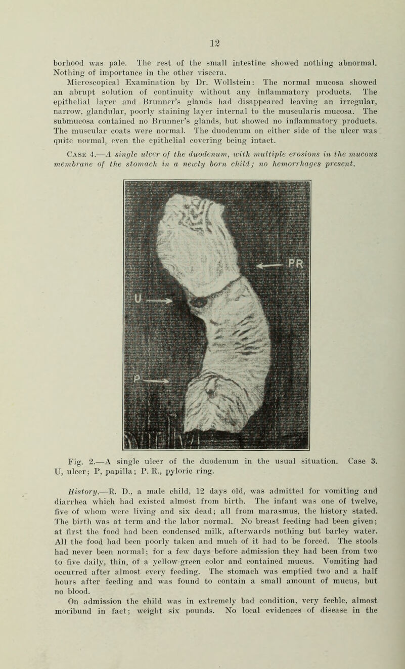 borliood was pale. The rest of the small intestine showed nothing abnormal. Nothing of importance in the other viscera. Microscopical Examination by Dr. Wollstein: The normal mucosa showed an abrupt solution of continuity without any inflammatory products. The epithelial layer and Brunner’s glands had disappeared leaving an irregular, narrow, glandular, poorly staining layer internal to the muscularis mucosa. The submucosa contained no Brunner’s glands, but showed no inflammatory products. The muscular coats were normal. The duodenum on either side of the ulcer was quite normal, even the ejuthelial covering being intact. Ca.se 4.—.1 single ulcer of the duodenum, iciih multiple erosions in the mucous membrane of the stomach in a newly born child; no hemorrhages present. Fig. 2.—A single ulcer of the duodenum in the usual situation. Case 3. U, ulcer; P, papilla; P. R., pyloric ring. History.—R. D., a male child, 12 days old, was admitted for vomiting and diarrhea which had existed almost from birth. The infant was one of twelve, five of whom were living and six dead; all from marasmus, the history stated. The birth was at term and the labor normal. No breast feeding had been given; at first the food had been condensed milk, afterwards nothing but barley water. All the food had been poorly taken and much of it had to be forced. The stools had never been normal; for a few days before admission they had been from two to five daily, thin, of a yellow-green color and contained mucus. Vomiting had occurred after almost every feeding. The stomach was emptied two and a half hours after feeding and was found to contain a small amount of mucus, but no blood. On admission the child was in extremely bad condition, very feeble, almost moribund in fact; weight six pounds. No local evidences of disease in the