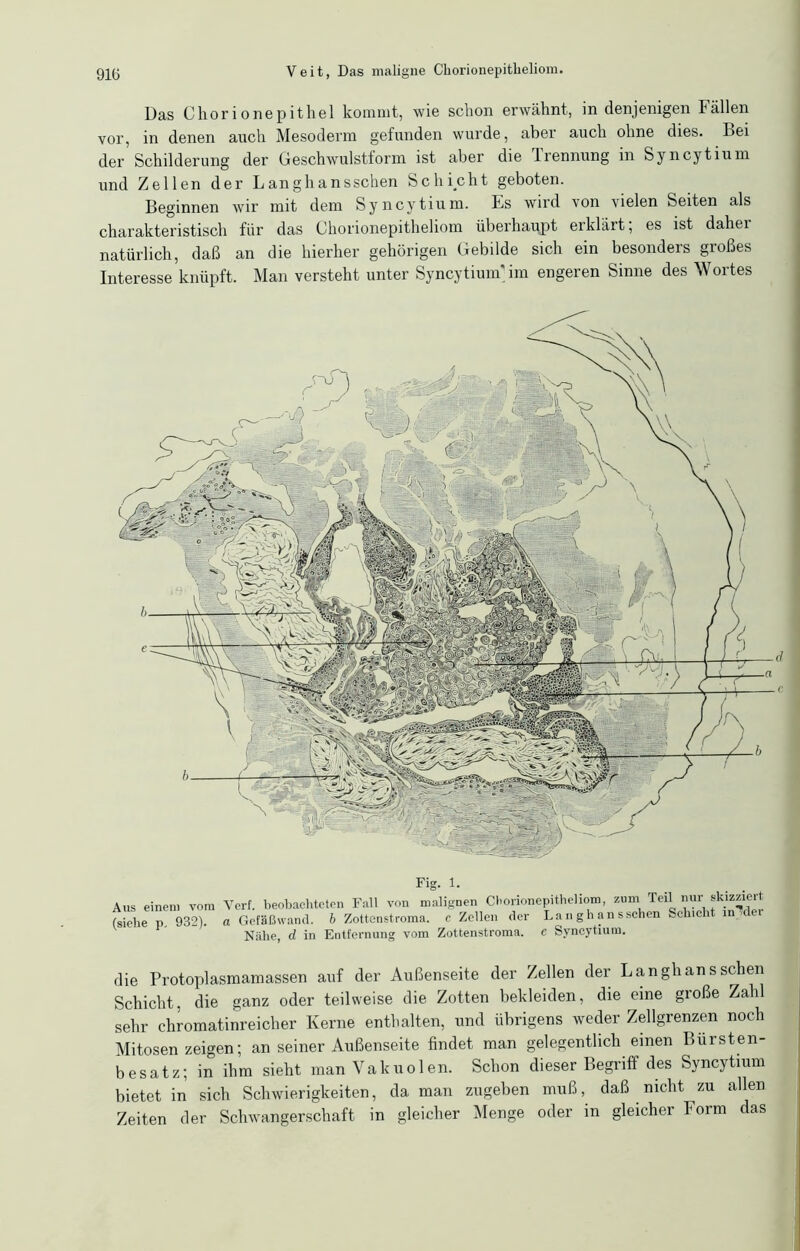 Fig‘ U .... ins einem vom Verf. beobachteten Fall von malignen Cl'orionepitheliom, zum Teil nur skizziert siebe p, 932). a Gefäßwand, b Zottenstroma, c Zellen der La n g h an sschen Schicht m dei Nähe, d in Entfernung vom Zottenstroma, e Svncytium. lie Protoplasmamassen auf der Außenseite der Zellen der Langhan sschen Schiebt, die ganz oder teilweise die Zotten bekleiden, die eine große Zahl sehr chromatinreicher Kerne enthalten, und übrigens weder Zellgrenzen noch Mitosen zeigen; an seiner Außenseite findet man gelegentlich einen Bürsten- besatz; in ihm sieht man Vakuolen. Schon dieser Begriff des Syncytmm bietet in sich Schwierigkeiten, da man zugeben muß, daß nicht zu allen Zeiten der Schwangerschaft in gleicher Menge oder in gleicher Form das Das Chor i o ne p ithel kommt, wie schon erwähnt, in denjenigen fällen vor, in denen auch Mesoderm gefunden wurde, aber auch ohne dies. Bei der Schilderung der Geschwulstform ist aber die Trennung in Syncytium und Zellen der Langhansschen Schicht geboten. Beginnen wir mit dem Syncytium. Es wird von vielen Seiten als charakteristisch für das Chorionepitheliom überhaupt erklärt; es ist dahei natürlich, daß an die hierher gehörigen Gebilde sich ein besonders großes Interesse knüpft. Man versteht unter Syncytium'im engeren Sinne des Wortes