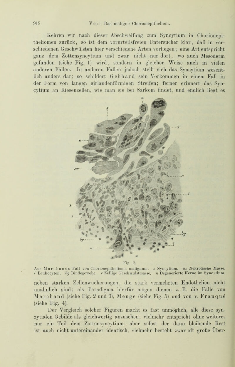 Kehren wir nach dieser Abschweifung zum Syncytium in Chorionepi- theliomen zurück, so ist dem vorurteilsfreien Untersucher klar, daß in ver- schiedenen Geschwülsten hier verschiedene Arten vorliegen; eine Art entspricht ganz dem Zottensyncytium und zwar nicht nur dort, wo auch Mesoderm gefunden (siehe Fig. 1) wird, sondern in gleicher Weise auch in vielen anderen Fällen. In anderen Fällen jedoch stellt sich das Syncytium wesent- lich anders dar; so schildert Gebhard sein Vorkommen in einem Fall in der Form von langen girlandenförmigen Streifen; ferner erinnert das Syn- cytium an Riesenzellen, wie man sie bei Sarkom findet, und endlich liegt es Ti Fig. 2. Aus Marcliands Fall von Chorionepithelioma rualignum. s Syncytium. ns Nekrotische Masse. I Leukocyten. bg Bindegewebe, c Zcllige Geschwulstmasse, n Degenerierte Kerne im Syncytium. neben starken Zellenwucherungen, die stark vermehrten Endothelien nicht unähnlich sind; als Paradigma hierfür mögen dienen z. B. die Fälle von March and (siehe Fig. 2 und 3), Menge (siehe Fig. 5) und von v. Franque (siehe Fig. 4). Der Vergleich solcher Figuren macht es fast unmöglich, alle diese syn- zytialen Gebilde als gleichwertig anzusehen; vielmehr entspricht ohne weiteres nur ein Teil dem Zottensyncytium; aber selbst der dann bleibende Rest ist auch nicht untereinander identisch, vielmehr besteht zwar oft große Über-