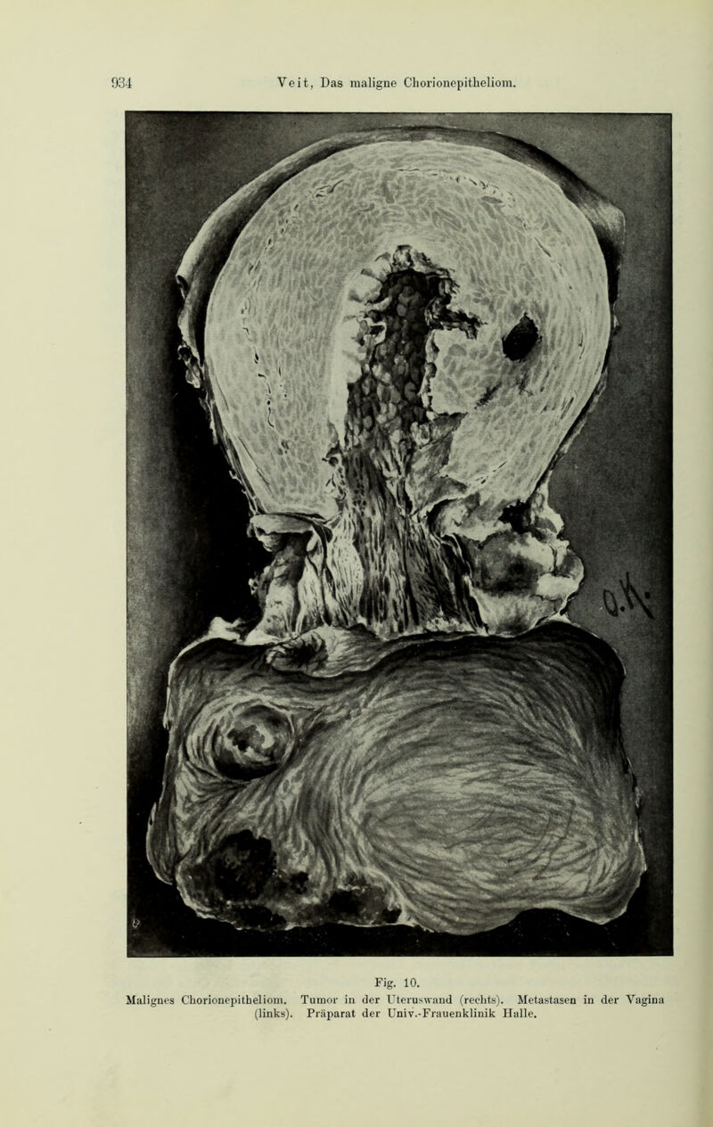 Fig. 10. Malignes Chorionepitheliom. Tumor in der Uteruswand (rechts). Metastasen in der Vagina (links). Präparat der Univ.-Frauenklinik Halle.