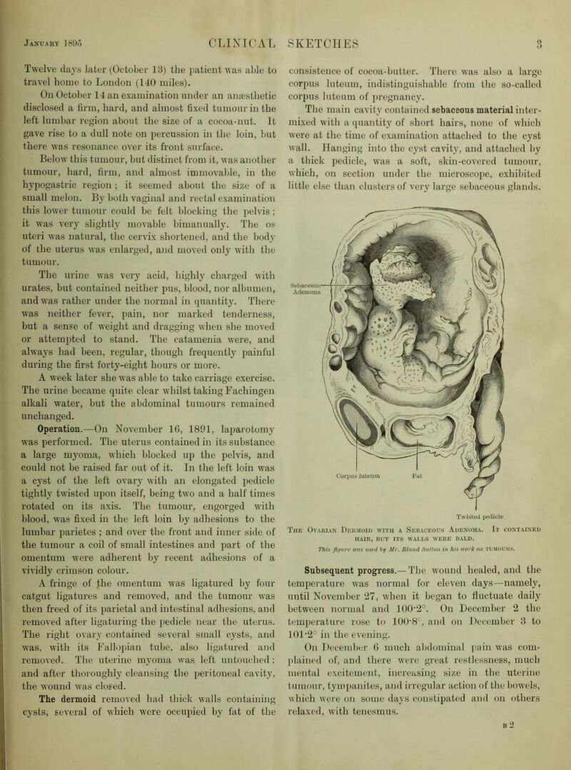 Twelve days later (October 13) the patient was able to travel home to London (140 miles). On October 14 an examination under an anjesthetic disclosed a firm, hard, and almost fixed tumour in the left lumbar region about the size of a cocoa-nut. It gave rise to a dull note on percussion in the loin, but there was resonance over its front surface. Below this tumour, but distinct from it, was another tumour, hard, firm, and almost immovable, in the hypogastric region ; it seemed about the size of a small melon. By both vaginal and rectal examination this lower tumour could be felt blocking the pelvis ; it was very slightly movable bimanually. The os uteri was natural, the cervix shortened, and the body of the uterus was enlarged, and moved only with the tumour. The urine was very acid, highly charged with urates, but contained neither pus, blood, nor albumen, and was rather under the normal in quantity. There was neither fever, pain, nor marked tenderness, but a sense of weight and dragging when she moved or attempted to stand. The catamenia were, and always had been, regular, though frequently painful during the first forty-eight hours or more. A week later she was able to take carriage exercise. The urine became quite clear whilst taking Fachingen alkali water, but the abdominal tumours remained unchanged. Operation.—On November IG, 1891, laparotomy was performed. The uterus contained in its substance a large myoma, which blocked up the pelvis, and could not be raised far out of it. In the left loin was a cyst of the left ovary with an elongated pedicle tightly twisted upon itself, being two and a half times rotated on its axis. The tumour, engorged with blood, was fixed in the left loin by adhesions to the lumbar parietes ; and over the front and inner side of the tumour a coil of small intestines and part of the omentum were adherent by recent adhesions of a vividly crimson colour. A fringe of the omentum was ligatured by four catgut ligatures and removed, and the tumour was then freed of its parietal and intestinal adhesions, and removed after ligaturing the pedicle near the uterus. The right ovary contained several small cysts, and was, with its Fallopian tube, also ligatured and removed. The uterine myoma was left untouched ; and after thoroughly cleansing the peritoneal cavity, the wound was closed. The dermoid removed had thick walls containing cysts, several of which were occupied by fat of the consistence of cocoa-butter. There was also a large corpus luteum, indistinguishable from the so-called corpus luteum of pregnancy. The main cavity contained sebaceous material inter- mixed with a quantity of short hairs, none of which were at the time of examination attached to the cyst wall. Hanging into the cyst cavity, and attached by a thick pedicle, was a soft, skin-covered tumour, which, on section under the microscope, exhibited little else than clusters of very large sebaceous glands. Twisted pedicle The Ovarian Dermoid with a Sebaceous Adenoma. It contained HAIR, BUT ITS WALLS WERE BALD. This Jjijure was used hy ^fr. Bland Satlon in his work on tumours. Subsequent progress.—The wound healed, and the temperature was normal for eleven days—namely, until November 27, when it began to fluctuate daily between normal and 100'2°. On December 2 the temperature rose to 100'8°, and on December 3 to 101‘2° in the evening. On December 6 much abdominal imin was com- plained of, and there were great restlessness, much mental excitement, increasing size in the uterine tumour, tympanites, and irregular action of the bowels, which were on some days constipated and on others relaxed, with tenesmus. B 2