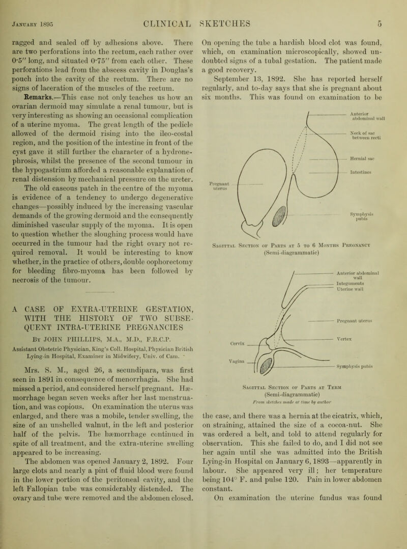 ragged and sealed off by adhesions above. There are two jierforations into the rectum, each rather over 0-5 long, and situated 0-75 from each other. These perforations lead from the abscess cavity in Douglas’s pouch into the cavity of the rectum. There are no signs of laceration of the muscles of the rectum. Remarks.—This case not only teaches us how an ovarian dermoid may simulate a renal tumour, but is very interesting as showing an occasional complication of a uterine myoma. The great length of the pedicle allowed of the dermoid rising into the ileo-costal region, and the position of the intestine in front of the cyst gave it still further the character of a hydrone- phrosis, whilst the presence of the second tumour in the hypogastrium afforded a reasonable explanation of renal distension by mechanical pressure on the ureter. The old caseous patch in the centre of the myoma is evidence of a tendency to undergo degenerative changes—possibly induced by the increasing vascular demands of the growing dermoid and the consequently diminished vascular supply of the myoma. It is open to question whether the sloughing process would have occurred in the tumour had the right ovary not re- quired removal. It would be interesting to know whether, in the practice of others, double oophorectomy for bleeding fihro-myoma has been followed by necrosis of the tumour. A CASE OF EXTRA-UTEBINE GESTATION, WITH THE HISTORY OF TWO SUBSE- QUENT INTRA-UTERINE PREGNANCIES By JOHN PHILLIPS, M.A., M.D., F.K.C.P. Assistant Obstetric Physician, King’s Coll. Hospital, Physician British Lying-in Hospital, Examiner in Midwifery, Univ. of Cam. ■ Mrs. S. M., aged 26, a secundipara, was first seen in 1891 in consequence of menorrhagia. She had missed a period, and considered herself pregnant. Hte- morrhage began seven weeks after her last menstrua- tion, and was copious. On examination the uterus was enlarged, and there was a mobile, tender swelling, the size of an unshelled walnut, in the left and posterior half of the pelvis. The luemorrhage continued in spite of all treatment, and the extra-uterine swelling appeared to be increasing. The abdomen was opened -January 2, 1892. Four large clots and nearly a pint of fluid blood were found in the lower portion of the peritoneal cavity, and the left Fallopian tube was considerably distended. The ovary and tul)e were removed and the abdomen closed. On opening the tube a hardish blood clot was found, which, on examination microscopically, showed un- doubted signs of a tubal gestation. The patient made a good recovery. September 13, 1892. She has reported herself regularly, and to-day says that she is pregnant about six months. This was found on examination to he Anterior abdominal wall Neck of sac between recti Hernial sac Intestines Rympliysis pubis Sagittal Section of Parts at 5 to G Months PuEtiXAXCY (Semi-diagrammatic) Sagittal Section of Parts at Term (Semi-diagrammatic) From sketches made af time by author the case, and there was a hernia at the cicatrix, which, on straining, attained the size of a cocoa-nut. She was ordered a belt, and told to attend regularly for observation. This she failed to do, and I did not see her again until she was admitted into the British Lying-in Hospital on .January 6,1893—apparently in labour. She appeared very ill; her temperature being 104° F. and pulse 120. Pain in lower abdomen constant. On examination the uterine fundus was found
