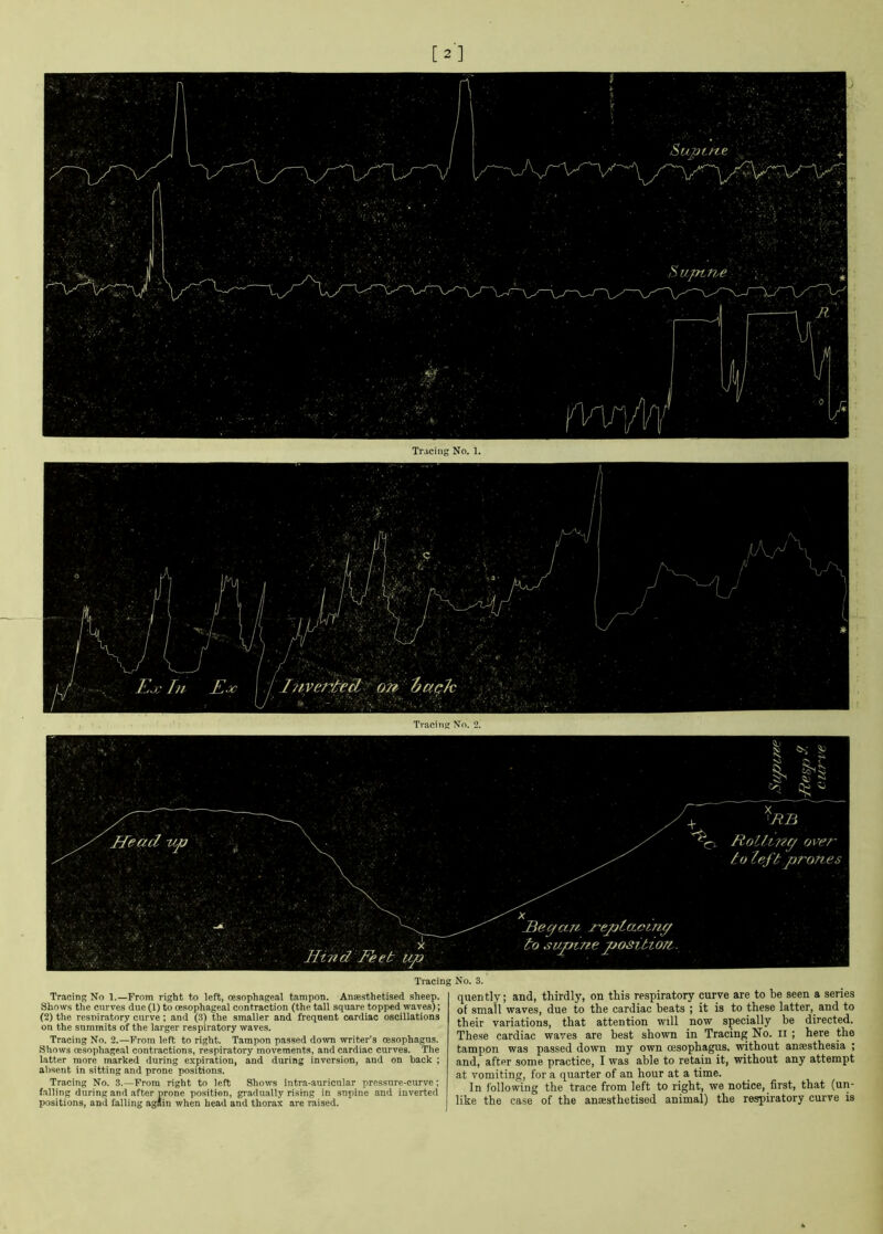 [2] Tracing No. 2. Tracing >»o. 3. Tracing No 1.—From right to left, oesophageal tampon. Anaesthetised sheep. Shows the curves due (1) to oesophageal contraction (the tall square topped waves); (2) the respiratory curve ; and (3) the smaller and frequent cardiac oscillations on the summits of the larger respiratory waves. Tracing No. 2.—From left to right. Tampon passed down writer’s oesophagus. Shows oesophageal contractions, respiratory movements, and cardiac curves. The latter more marked during expiration, and during inversion, and on back ; absent in sitting and prone positions. Tracing No. 3.—From right to left Shows intra-auricular pressure-curve; falling during and after nrone position, gradually rising in supine and inverted positions, and falling again when head and thorax are raised. quently; and, thirdly, on this respiratory curve are to be seen a series of small waves, due to the cardiac beats ; it is to these latter, and to their variations, that attention will now specially be directed. These cardiac waves are best shown in Tracing No. II ; here the tampon was passed down my own oesophagus, without anaesthesia ; and, after some practice, I was able to retain it, without any attempt at vomiting, for a quarter of an hour at a time. In following the trace from left to right, we notice, first, that (un- like the case of the anaesthetised animal) the respiratory curve is