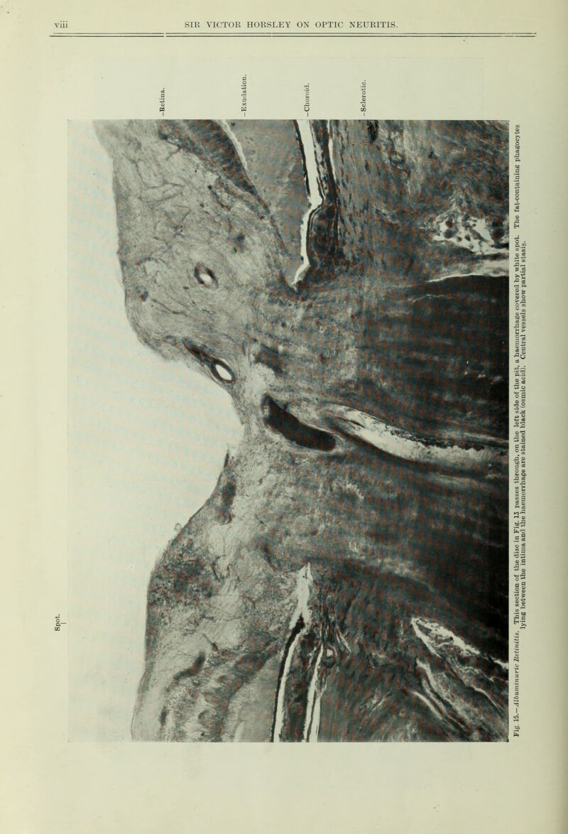 Spot. Fig, 15.—Albuminuric Retinitis. This section of the disc in Fig. 13 passes through, on the left side of the pit, a haemorrhage covered by white spot. The fat-containing phagocytes lying between the intima and the haemorrhage are stained black (osmic acid). Central vessels show partial stasig.