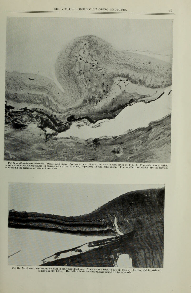 XI ♦ \  Fig. 20.—Albuminuric Retinitis. Osmic acid stain. Section through the swollen macula anr Fifi- 13. The oedematous retina The smaller corpuscles are leucocytes. ...-SeoMon o,