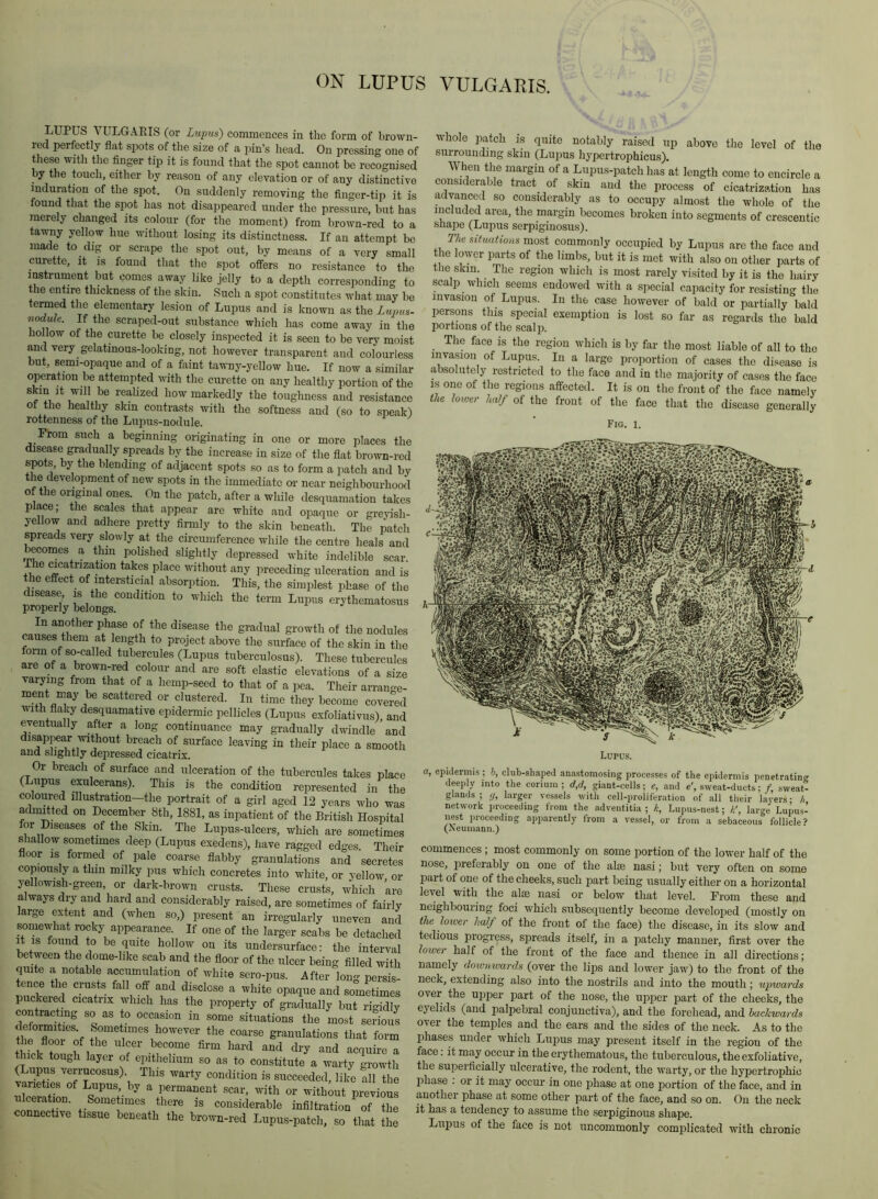 ON LUPUS VULGARIS. LUPUS VULGARIS (or Lupus) commences in the form of brown- red perfectly flat spots of the size of a pin’s head. On pressing one of these with the finger tij) it is found that the spot cannot be recognised by the touch, either by reason of any elevation or of any distinctive mduration of the spot. On suddenly removing the finger-tip it is found that the spot has not disappeared under the pressure, but has merely changed its colour (for the moment) from brown-red to a tawny yellow hue without losing its distinctness. If an attempt be made to dig or scrape the spot out, by means of a very small curette, it is found that the spot offers no resistance to the instrument but comes away like jelly to a depth corresponding to the entire thickness of the skin. Such a spot constitutes what may be termed the elementary lesion of Lupus and is known as the Lupus- nodule. If the scraped-out substance which has come away in the hollow of the curette be closely inspected it is seen to be very moist and very gelatinous-looking, not however transparent and colourless but, semi-opaque and of a faint tawny-yellow hue. If now a similar operation be attempted with the curette on any healthy portion of the skin It will be realized how markedly the toughness and resistance ot the healthy skin contrasts with the softness and (so to speak) rottenness of the Lupus-nodule. From such a beginning originating in one or more places the disease gradually spreads by the increase in size of the flat brown-red spots, by the blending of adjacent spots so as to form a patch and by the development of new spots in the immediate or near neighbourhood of the oripnal ones. On the patch, after a while desquamation takes place; the scales that appear are white and opaque or greyish- yellow and adhere pretty firmly to the skin beneath. The patch spreads very slowly at the circumference while the centre heals and becomes a thin polished slightly depressed white indelible scar. The cicatrization takes place without any preceding ulceration and is the effect of intersticial absorption. This, the simplest phase of the disease, is the condition to which the term Lupus erythematosus properly belongs. In another phase of the disease the gradual growth of the nodules causes them at length to project above the surface of the skin in the form of so-called tubercules (Lupus tuberculosus). These tubercules are of a brown-red colour and are soft elastic elevations of a size varying from that of a hemp-seed to that of a pea. Their arrano-e- ment may be scattered or clustered. In time they become covered with flaky desquamative epidermic pellicles (Lupus exfoliativus), and eventually after a long continuance may gradually dwindle and disappear without breach of surface leaving in their place a smooth and slightly depressed cicatrix. whole patch is quite notably raised up above the level of the surrounding skin (Liijius hypertrophicus). When the margin of a Lupus-patch has at length come to encircle a considerable tract_ of skin and the process of cicatrization has advanced so considerably as to occupy almost the whole of the included area, the margin becomes broken into segments of crescentic snape (Lupus serpiginosus). The situations most commonly occupied by Lupus are the face and the lower parts of the limbs, but it is met with also on other parts of the skin The region which is most rarely visited by it is the hairy scalp which seems endowed with a special capacity for resisting the invasion of Lupus. In the case however of bald or partially bald persons this special exemption is lost so fiir as regards the bald portions of the scalp. The face is the region which is by far the most liable of all to the invasion of Lupus. In a large proportion of cases the disease is absolutely restricted to the face and in the majority of cases the face IS one of the regions affected. It is on the front of the face namely the lower half of the front of the face that the disease generally Fig. 1. Lupus. Or breach of surface and ulceration of the tubercules takes pla (Lupus exulcerans). This is the condition represented in t coloured illustration-the portrait of a girl aged 12 years who w admitted on December 8th, 1881, as inpatient of the British Hospit for Diseases of the Skin. The Lupus-ulcers, which are sonietim shallow sometimes deep (Lupus exedens), have ragged ed^es The floor IS formed of pale coarse flabby granulations and secret copiously a thin milky pus which concretes into white, or vellow ( yellowish-green, or dark-brown crusts. These crusts, which a: always dry and hard and considerably raised, are sometimes of fair large extent and (when so,) present an irregularly uneven an somewhat rocky appearance. If one of the larger scabs be detache It IS found to be quite hollow on its undersurface: the intervi between the dome-like scab and the floor of the ulcer being filled wit quite a notable accumulation of white sero-pus. After Ion- persi: tence the cnists fall off and disclose a white opaque and soLetimt puckeied cicatrix which has the property of gradually but rigidl contracting so as to occasion in some situations the most seriou deformities. Sometimes however the coarse granulations that fori thick tough layer of epithelium so as to constitute a warty growt ( upus verrucosus). This warty condition is succeeded, like all th varieties of Lupus by a permanent scar, with or without previou ulceration. Sometimes there is considerable infiltration^ of th connective tissue beneath the brown-red Lupus-patch, so that th a, epidermis; b, club-shaped anastomosing processes of the epidermis penetrating deeply into the corium ; d,d, giant-cells; e, and e', sweat-ducts; /, sweat- glands ; larger vessels with cell-proliferation of all their la\'ers * // network i.roceeding from the adventitia ; k, Lupus-nest; large Lupus- nest proceeding apparently from a vessel, or from a sebaceous follicle? (Neumann.) commences ; most commonly on some portion of the lower half of the nose, preferably on one of the aim nasi; but very often on some part of one of the cheeks, such part being usually either on a horizontal level with the aim nasi or below that level. From these and neighbouiing foci which subsequently become developed (mostly on the lower half of the front of the face) the disease, in its slow and tedious progress, spreads itself, in a patchy manner, first over the lower half of the front of the face and thence in all directions; namely downwards (over the lips and lower jaw) to the front of the neck, extending also into the nostrils and into the mouth; upwards over the upper part of the nose, the uppier part of the cheeks, the eyelids (and palpebral conjunctiva), and the forehead, and backwards over the temples and the ears and the sides of the neck. As to the phases under which Lupus may present itself in the region of the face: it may occur in the erythematous, the tuberculous, the exfoliative, the superficially ulcerative, the rodent, the warty, or the hypertrophic phase . or it may occur in one phase at one portion of the face, and in another phase at some other part of the face, and so on. On the neck it has a tendency to assume the .serpiginous shape. Lupus of the face is not uncommonly complicated with chronic
