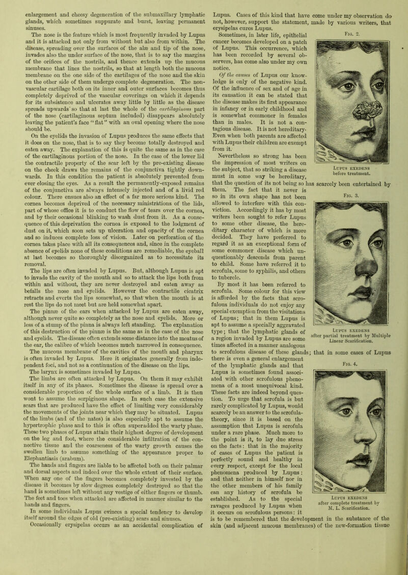 enlargement and cheesy degeneration of the submaxillary lymphatic glands, which sometimes suppurate and burst, leaving permanent sinuses. The nose is the feature which is most frequently invaded by Lupus and it is attacked not only from without but also from within. The disease, spreading over the surfaces of the aim and tijj of the nose, invades also the under surface of the nose, that is to say the margins of the orifices of the nostrils, and thence extends up the mucous membrane that lines the nostrils, so that at length both the mucous membrane on the one side of the cartilages of the nose and the skin on the other side of them undergo complete degeneration. The non- vascular cartilage both on its inner and outer surfaces becomes thus completely deiu'ived of the vascular coverings on which it depends for its subsistence and ulcerates away little by little as the disease spreads upwards'so that at last the whole of the cartilaginons part of the nose (cartilaginous septum included) disappears absolutely leaving the patient’s face “ flat ” with an oval opening where the nose should be. On the eyelids the invasion of Lupus produces the same effects that it does on the nose, that is to say they become totally destroyed and eaten away. The explanation of this is quite the same as in the case of the cartilaginous portion of the nose. In the case of the lower lid the contractile iDi’operty of the scar left by the pre-existing disease on the cheek draws the remains of the conjunctiva tightly down- wards. In this condition the patient is absolutely prevented from ever closing the eyes. As a result the permanently-exposed remains of the conjunctiva are always intensely injected and of a livid red colour. There ensues also an effect of a far more serious kind. The cornea becomes deprived of the necessary ministrations of the lids, part of whose office it is to conduct the flow of tears over the cornea, and by their occasional blinking to wash dust from it. As a conse- quence of this deprivation the cornea is exposed to the lodgment of dust on it, which soon sets up ulceration and opacity of the cornea and so induces complete loss of vision. Later on perforation of the cornea takes place with all its consequences and, since in the complete absence of ey-clids none of these conditions are remediable, the eyeball at last becomes so thoroughly disorganized as to necessitate its removal. The lips are often invaded by Lupus. But, although Lupus is apt to invade the cavity of the mouth and so to attack the lips both from within and without, they are never destroyed and eaten away as befalls the nose and eyelids. However the contractile cicatrix retracts and everts the lips somewhat, so that when the mouth is at rest the lips do not meet but are held somewhat apart. The pinnm of the ears when attacked by Lupus are eaten away, although never quite so completely as the nose and eyelids. More or less of a stump of the pinna is always left standing. The explanation of this destruction of the pinnse is the same as in the case of the nose and eyelids. The disease often extends some distance into the meatus of the ear, the calibre of which becomes much narrowed in consequence. The mucous membrane of the cavities of the mouth and pharynx is often invaded by Lupus. Here it originates generally from inde- pendent foci, and not as a continuation of the disease on the lips. The larynx is sometimes invaded by Lupus. The limbs are often attacked by Lupus. On them it may exhibit itself in any of its phases. Sometimes the disease is spread over a considerable proportion of the whole surface of a limb. It is then wont to assume the serpiginous shai^e. In such case the extensive scars that are produced have the effect of limiting very considerably the movements of the joints near whicli they may be situated. Lupus of the limbs (and of the nates) is also especially apt to assume the hypertrophic phase and to this is often superadded the warty phase. These two phases of Lupus attain their highest degree of development on the leg and foot, where the considerable infiltration of the con- nective tissue and the coarseness of the warty growth causes the swollen limb to assume something of the appearance proper to Elephantiasis (arabum). The hands and fingers are liable to bo affected both on their palmar anrl dor.sal aspects and indeed over the whole extent of their surface. When any one of the fingers becomes completely invested by the disease it becomes by slow degrees completely destroyed so that the hand is sometimes left without any vestige of either fingers or thumb. The feet and toes when attacked are affected in manner similar to the hands and fingers. In some individuals Lupus evinces a special tendency to develop it.self around the edges of old (pre-existing) scars and sinuses. Occasionally erysipelas occurs as an accidental complication of Fio. Lupus exedens before treatment. Fig. 3. Lupus. Cases of this kind that have come under my observation do not, however, support the statement, made by various writers, that erysipelas cures Lupus. Sometimes, in later life, epithelial cancer becomes developed on a patch of Lupus. This occurrence, which has been recorded by several ob- servers, has come also under my own notice. Of the causes of Lrrpus our know- ledge is only of the negative kind. Of the influence of sex and of age in its causation it can be stated that the disease makes its first appearance in infancy or in early childhood and is somewhat commoner in females than in males. It is not a con- tagious disease. It is not hereditary- Even when both parents are affected with Lupus their children are exempt from it. Nevertheless so strong has been the impression of most writers on the subject, that so striking a disease must in some way be hereditary, that the question of its not being so has scarcely been entertained by them. The fact that it never is so in its own shape has not been allowed to interfere with this con- viction. Accordingly it has by most writers been sought to refer Lupus to some other disease, the here- ditary character of which is more decided. They have preferred to regard it as an exceptional form of some commoner disease which un- questionably descends from parent to child. Some have referred it to scrofula, some to syphilis, and others to tubercle. By most it has been referred to scrofula. Some colour for this view is afforded by the facts that scro- fulous individuals do not enjoy any special exemption from the visitations of Lupus; that in them Lupus is apt to assume a specially aggravated type; that the lymphatic glands of a region invaded by Lupus are some times affected in a manner analogous to scrofulous disease of these glands; that in some cases of Lupus there is even a general enlargement of the lymphatic glands and that Lupus is sometimes found associ- ated with other scrofulous pheno- mena of a most unequivocal kind. These facts are indeed beyond ques- tion. To urge that scrofula is but rarely complicated by Lupus, would scarcely be an answer to the scrofula- theory, since it is based on the assumption that Lupus is scrofula under a rare phase. Much more to the point is it, to lay due stress on the facts: that in the majority of cases of Lupus the patient is perfectly sound and healthy in every respect, except for the local phenomena produced by Lujras: and that neither in himself nor in the other members of his family can any history of scrofula be established. As to the special ravages produced by Lupus when it occurs on scrofulous persons: it is to be remembered that the develo2)ment in the substance of the skin (and adjacent mucous membranes) of the new-formation tissue Lupus exedess after partial treatment by Multiple Linear Scarification. Fig. 4. Lupus exedexs after complete treatment by M. L. Scarification.