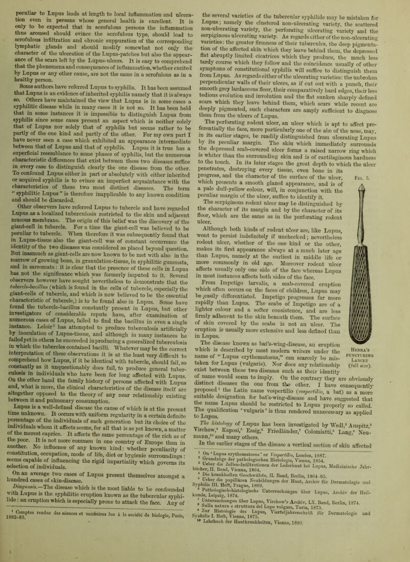 peculiar to Lupus leads at IcDgtli to local iuflaruination and ulcera- tion even in persons whose general health is excellent. It is only to be expected that in scrofulous persons the inflammation thus aroused should evince the scrofulous type, should lead to scrofulous infiltration and chronic suppuration of the corresponding lymphatic glands and should modify somewhat not onjy the character of the ulceration of the Lu]:)us-patches but also the appear- ance of the scars left by the Lupus-ulcers. It is easy to comprehend that the phenomena and consequences of inflammation, whether excited by Lupus or any other cause, are not the same in a scrofulous as in a healthy person. Some authors have refei’red Lupus to syphilis. It has been assumed that Lupus is an evidence of inherited syphilis namely that it is always so. Others have maintained the view that Lupus is in some cases a syphilitic disease while in many cases it is not so. It has been held that in some instances it is impossible to distinguish Lupus from .syphilis since some cases present an aspect which is neither solely that of Lupus nor solely that of syphilis but seems rather to be partly of the one kind and partly of the other. For my own part I have never seen a case which exhibited an appearance intermediate between that of Lupus and that of syphilis. Lupus it is tme has a superficial resemblance to some i^hases of syphilis, but the numerous characteristic differences that exi.st between these two diseases suffice in every case to distinguish clearly the one disease from the other. To confound Lupus either in part or absolutely with either inherited or acquired syphilis is to evince an imperfect acquaintance with the characteristics of these two most distinct diseases. The term “ syphilitic Lupus ” is therefore inapplicable to any known condition and should be discarded. Other observers have referred Lupus to tubercle and have regarded Lupus as a localized tuberculosis restricted to the skin and adjacent mucous membrane. The origin of this belief was the discovery of the giant-cell in tubercle. For a time the giant-cell was believed to be peculiar to tubercle. When therefore it was subsequently found that in Lupus-tissue also the giant-cell was of constant occurrence the identity of the two diseases was considered as placed beyond question. But inasmuch as giant-cells are now known to be met with also in the marrow of growing bone, in granulation-tissue, in syphilitic gummata, and in sarcomata; it is clear that the presence of these cells in Lupus has not the significance which was formerly imputed to it. Several observers however have sought nevertheless to demonstrate that the tulercle-baciUus (which is found in the cells of tubercle, especially the giant-cells of tubercle, and which is now believed to be the essential characteristic of tubercle,) is to be found also in Lupus. Some have found the tubercle-bacillus constantly present in Lupus, but other investigators of considerable rej^ute have, after examination of numerous cases of Lupus, failed to find the bacillus in even a single instance. Leloir’ has attempted to produce tuberculosis artificiaUy by inoculation of liupus-tissue, and although in many instances he failed yet in others he succeeded in producing a generalized tuberculosis in which the tubercles contained bacilli. Whatever may be the correct interpretation of these observations it is at the least very difficult to comprehend how Lupus, if it be identical with tubercle, should fail so constantly as it unquestionably does fail, to produce general tuber- culosis in individuals who have been for long affected with Lupus. On the other hand the family history of persons affected with Lupus and, what is more, the clinical characteristics of the disease itself arc altogether opposed to the theory of any near relationship existiu”’ between it and pulmonary consumption. ° Lupus is a well-defined disease the cause of which is at the present time unknown. It occurs with uniform regularity in a certain definite percentage of the individuals of each generation but its choice of the individuals whom it affects seems, for all that is as yet known, a matter of the merest caprice. It affects the same percentage of the rich as of the poor. It is not more common in one country of Europe than in another. No influence of any known kind: whether peculiarity of constitution, occupation, mode of life, diet or hygienic surroundings : seems capable of influencing the rigid impartiality which governs its selection of individuals. On an average two cases of Lupus present themselves amongst a hundred cases of skin-disease. D<aflrnosis.--The disease which is the most liable to be confounded with Lupus is the syphilitic eruption known as the tubercular syphi- lide: an eruption which is e.specially prone to attack the face. Any of the several varieties of the tubercular syphilide may be mistaken for Lupus, namely the clustered non-ulcerating variety, the scattered non-ulcerating variety, the perforating ulcerating variety and the serpiginous ulcerating variety. As regards cither of the non-ulcerating vaiieties. the greater firmness of their tuberculcs, the deep pigmenta- tion of the aflected skin which they leave behind them, the depressed flat abruptly limited cicatrices which they produce, the much less tardy course which they follow and the coincidence usually of other symptoms of constitutional syphilis will suffice to distinguish them from Lupus. As regards either of the ulcerating varieties: the unbroken perpendicular walls of their ulcers, as if cut out with a punch, their smooth grey lardaceous floor, their comparatively hard edges, their less tedious evolution and involution and the flat sunken sharply-defined scars which they leave behind them, which scars while recent are deeply pigmented, such characters are amply sufficient to diagnose them from the ulcers of Lupus. The perforating rodent ulcer, an ulcer which is apt to affect pre- ferentially the face, more particularly one of the aim of the nose, may, in its earlier stages, be readily distinguished from ulcerating Lupus by its peculiar margin. The skin which immediately surrounds the depressed scab-covered ulcer forms a raised narrow ring which IS whiter than the surrounding skin and is of cartilaginous hardness to the touch. In its later stages the great depth to which the ulcer penetrates, destroying every tissue, even bone in its progress, and the character of the surfiice of the ulcer, which presents a smooth glazed appearance, and is of a pale dull-yellow colour, will, in conjunction with the peculiar margin of the ulcer, suffice to identify it. The serpiginous rodent ulcer may be distinguished by the character of its margin and by the character of its floor, which are the same as in the perforating rodent ulcer. Although both kinds of rodent ulcer are, like Lupus, wont to persist indefinitely if unchecked; nevertheless rodent ulcer, whether of the one kind or the other, makes its first appearance always at a much later age than Lupu.s, namely at the earliest in middle life or more commonly in old age. Moreover rodent ulcer affects usually only one side of the face whereas Lujius in most instances affects both .sides of the face. From Impetigo larvalis, a scab-covered eruption which often occurs on the faces of children. Lupus may be .easily differentiated. Impetigo progresses far more rapidly than Lupus. The scabs of Impetigo are of a lighter colour and a softer consistence, and are less firmly adherent to the skin beneath them. The surface of skin covered by the scabs is not an ulcer. The eruption is usually more extensive and less defined than in Lupus. The disease known as bat’s-wing-disease, an eruption which is described by most modern writers under the name of “ Lupus erythematosus,” can scarcely be mis- taken for Lupus (vulgaris). Nor does any relationship exist between these two diseases such as their identity of name would seem to imply. On the contrary they are obviously distinct diseases the one from the other. I have consequently proposed * the Latin name vespertilio {vespertilio, a bat) as a more suitable designation for bafs-wing-disease and have suggested that the name Lupus should be restricted to Lupus properly so called. The qualification ' vulgaris ’ is thus rendered unnecessary as applied to Lupus. The histology of Lupus has been investigated by Wedb^ Auspitz,* Virchow,^ Kaposi,® Essig,® Friedlander,'^ Colomiatti,® Lang,® Neu- mann,’® and many others. In the earlier stages of the disease a vertical section of skin affected Heuka’s PUNCTUKING Lancet (full size). 1882-83 swnces et merfioires lus i la sodete de biologic, Paris, 2 On ‘Lupus erythematosus’ or Vespertilio, l^onAow, 1887. ^ Grundziige der pathologischeu Histologic, Vienna, 1854 bifch^T ’ Die krankhaften Geschwiilste, II. Band, Berlin, 18G4-65. Svnhir''« pupillUren Ncubildungen der Haul, Ardiiv fur Dermatologic und bvphihs III. Hett, Prague, 1869. ° Pathologisch-histologische Untersuchungen uber Lupus, Archiv der Heil- kunde, Leipzig, 1874. ' Untersuchungen fiber Lupus, Virchow’s Archiv, LX. Band, Berlin, 1874. bulla natura e struttura del Lupo volgare, Turin, 1875. « Vierteljahresschr’ift ffi'r Dermatologic und Syphilis I. Heft, Vienna, 1875. ** Lehrbuch der Hautkrankheiten, Vienna, 1880.