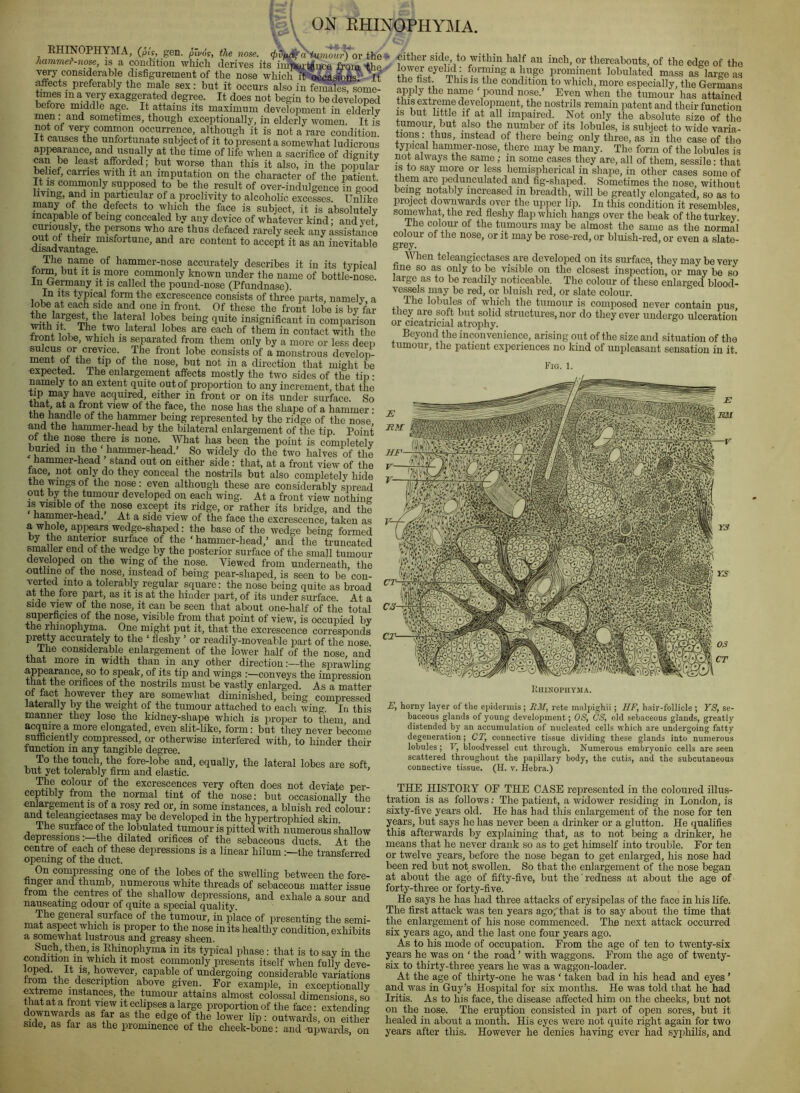 EHINOPHYMA, (pis, gen. pipos, the nose. 4>vudif a'iumour) or the hammer -nose, is a condition which derives its imitortf nee from ^e very considerable disfigurement of the nose which I? affects preferably the male sex: but it occurs also in females’, some- times in a very exaggerated degree. It does not begin to be developed before middle age. It attains its maximum development in eldm-ly men: and sometimes, though exceptionally, in elderly women. It is not of very common occurrence, although it is not a rare condition It causes the unfortunate subject of it to present a somewhat ludicrous appearance, and usually at the time of life when a sacrifice of dignity nan be least afforded; but worse than this it also, in the popular belief, carries with it an imputation on the character of the patient It IS cominonly supposed to be the result of over-indulgence in good living, and in particular of a proclivity to alcoholic excesses. Unlike m to the face is subject, it is absolutely incapable of being concealed by any device of whatever kind; and yet curiously, the persons who are thus defaced rarely seek any assistance dladva*ntage“^^^“'*““^’ content to accept it as an inevitable The name of hammer-nose accurately describes it in its typical torm, but it is more commonly known under the name of bottle-nose. In Germany it is called the pound-nose (Pfundnase). to Its typical form the excrescence consists of three parts, namely a lobe at each side and one in front. Of these the front lobe is by far toe large^ the lateral lobes being quite insignificant in comparison with It. The two lateral lobes are each of them in contact with the front lobe, which is ^parated from them only by a more or less deep sulcus or crevice. The front lobe consists of a monstrous develop- ment of the tip of the nose, but not in a direction that might be expected. The enlargement affects mostly the two sides of the tip: namely to an extent quite out of proportion to any increment that the tip may have acquired, either in front or on its under surface. So that, at a front view of the face, the nose has the shape of a hammer • the handle of the hammer being represented by the ridge of the nose hammer-head by the bilateral enlargement of the tip Point of the nose there is none. What has been the point is completely buried in the hammer-head.’ So widely do the two halves of the hammer-head stand out on either side: that, at a front view of the race, pt only do they eonceal the nostrils but also completely hide the wings of the nose; even although these are considerably spread out by the tumour developed on each wing. At a front view nothing IS visible of the nose except its ridge, or rather its bridge, and the hammer-head. At a side view of the face the excrescence, taken as a whole, appears wedge-shaped: the base of the wedge being formed by the anterior surface of the ‘hammer-head,’ and toe truncated smaller end of the wedge by the posterior surface of the small tumour developed on the wmg of the nose. Viewed from underneath, the putline of the nose, instead of being pear-shaped, is seen to be con- verted into a tolerably regular square: the nose being quite as broad at the fore part, as it is at the hinder part, of its under surface. At a side view of the nose, it can be seen that about one-half of the total superficies of the nose, visible from that point of view, is occupied by the rhinophyma. One might put it, that the excrescence corresponds pr^ty accurately to the ‘ fleshy ’ or readily-moveable part of the nose. ihe considerable enlargement of the lower half of the nose and that more in width than in any other direction:—the sprawling appearance, so to speak, of its tip and wings :—conveys the impression that the orifices of the nostrils must be vastly enlarged. A s a matter ot tact however they are somewhat diminished, being compressed laterally by the weight of the tumour attached to each wing. In this manner they lose the kidney-shape which is proper to them and ac^ire a more elongated, even slit-like, form: but they never become sufficiently compressed, or othenvise interfered with, to hinder their function in any tangible degree. p the touch the fore-lobe and, equally, toe lateral lobes are soft, but yet tolerably firm and elastic. The colour of the excrescences very often does not deviate per- ceptibly from the normal tint of the nose: but occasionally the enlargement is of a rosy red or, in some instances, a bluish red colour • and teleangiectases may be developed in the hypertrophied skin. The surface of the lobulated tumour is pitted with numerous shallow depressions: the dilated orifices of the sebaceous ducts At the centre of each of these depressions is a linear hilum :—the transferred opening of the duct. On compressing one of the lobes of the swelling between the fore- flnger and thumb, numerous white threads of sebaceous matter issue from the centres of the shallow depressions, and exhale a sour and nauseating odour of quite a special quality. The general surface of the tumour, in place of presenting the semi- mat aspect which is proper to the nose in its healthy condition, exhibits a somewhat lustrous and greasy sheen. Such, then, is Ehinophyma in its typical phase: that is to say in the condition in which it most commonly presents itself when fully deve- loped. It IS, however, capable of undergoing considerable variations from the description above given. For example, in exceptionally extreme instances, the tumour attains almost colossal dimensions so Jwnio eclipses a large proportion of the face: extending downwards as far as the edge of the lower lip: outwards, on either side, as far as the prominence of the cheek-bone: and upwards, on \ ON RHINOPHYMA. • either side to within half an inch, or thereabouts, of the edge of the lower eyeM: formng a huge prominent lobulated mass as large as the hst. This is the condition to which, more especially, the Germans apply the name ‘ pound nose.’ Even when the tumour has attained this extreme development, the nostrils remain patent and their function IS but little if at all impaired. Not only the absolute size of the tumour but also the number of its lobules, is subject to wide varia- rions: thus, instead of there being only three, as in the case of the typical hammer-iiose, there may be many. The form of the lobules is not always the same; in some cases they are, all of them, sessile • that IS to say more or less hemispherical in shape, in other cases some of them are pedunculated and fig-shaped. Sometimes the nose, without being notably increased in breadth, will be greatly elongated, so as to project downwards over the upjier lip. In this condition it resembles somewhat’ the red fleshy flap which hangs over the beak of the turkey’ Ihe colour of the tumours may be almost the same as the normai colour of the nose, or it may be rose-red, or bluish-red, or even a slate- When teleangiectases are developed on its surface, they may be very hne so as only to be visible on the closest inspection, or may be so large as to be readily noticeable. The colour of these enlarged blood- vessels may be red, or bluish red, or slate colour. The lobules of which the tumour is composed never contain pus they are soft but solid structures, nor do they ever undergo ulceration or cicatricial atrophy. Beyond the inconvenience, arising out of the size and situation of the tumour, the patient experiences no kind of unpleasant sensation in it. Fig 2i3I IlllINOPIIYJIA. E, hol'ny layer of the epidermis ; RM, rete malpighii ; IIF, hair-follicle ; YS, se- baceous glands of young development; 08, CS, old sebaceous glands, greatly distended by an accumulation of nucleated cells which are undergoing fatty degeneration; CT, connective tissue dividing these glands into numerous lobules; F, bloodvessel cut through. Numerous embryonic cells are seen scattered throughout the papillary body, the cutis, and the subcutaneous connective tissue. (H. v. Hebra.) THE HISTOEY OF THE CASE represented in the coloured illus- tration is as follows; The patient, a widower residing in London, is sixty-five years old. He has had this enlargement of the nose for ten yeps, but says he has never been a drinker or a glutton. He qualifies this afterwards by explaining that, as to not being a drinker, he means that he never drank so as to get himself into trouble. For ten or twelve years, before the nose began to get enlarged, his nose had been red but not swollen. So that the enlargement of the nose began at about the age of fifty-five, but the'redness at about the age of forty-three or forty-five. He says he has had three attacks of erysipelas of the face in his life. The first attack was ten years ago, that is to say about the time that the enlargement of his nose commenced. The next attack occurred six years ago, and the last one four years ago. As to his mode of occupation. From the age of ten to twenty-six years he was on ‘ the road ’ with waggons. From the age of twenty- six to thirty-three years he was a waggon-loader. At the age of thirty-one he was ‘ taken bad in his head and eyes ’ and w^as in Guy’s Hosjiital for six months. He was told that he had Iritis. As to his face, the disease affected him on the cheeks, but not on the nose. The eruption consisted in part of open sores, but it healed in about a month. His eyes were not quite right again for two years after this. However he denies having ever had syphilis, and