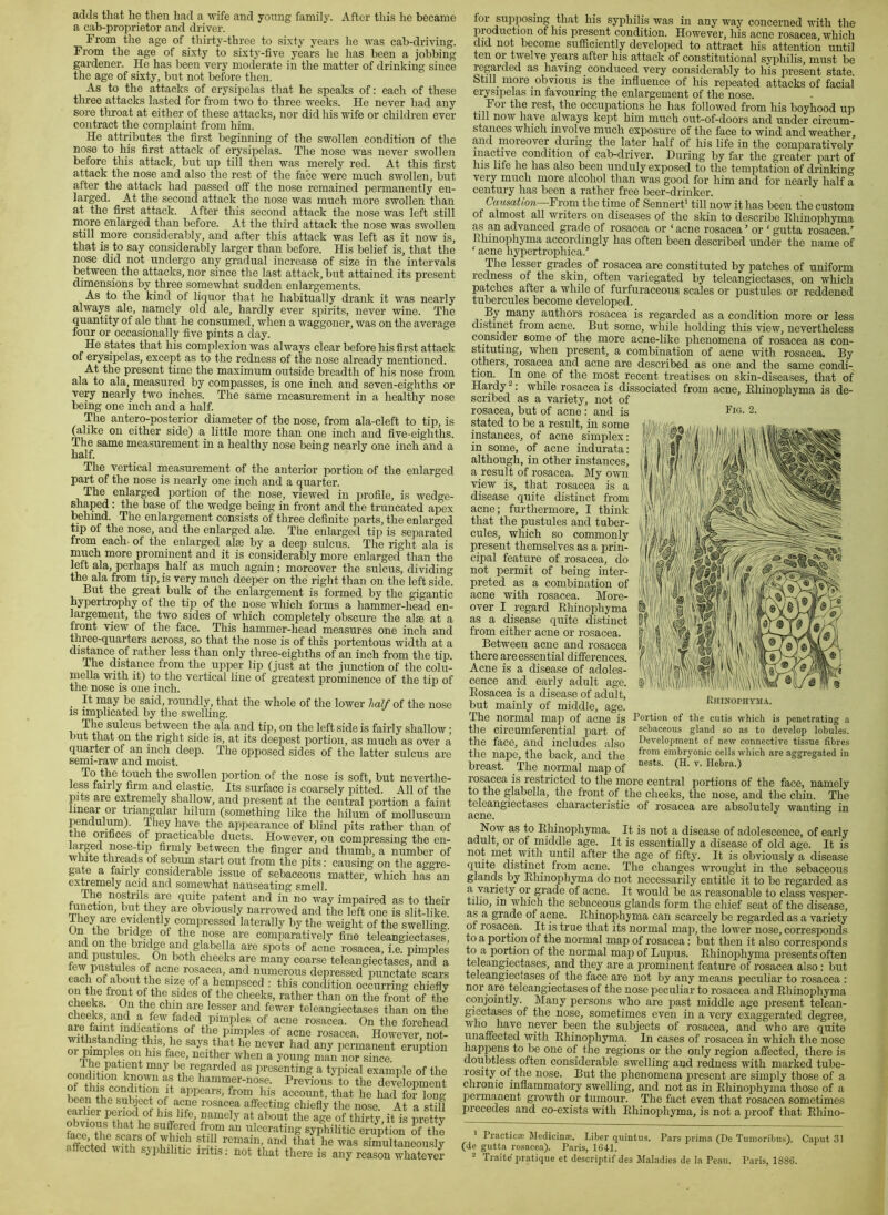 adds that he then had a wife and young family. After this he became a cab-proprietor and driver. From the age of thirty-three to sixty years lie was cab-driving. From the age of sixty to sixty-five years he has been a jobbing gardener. He has been very moderate in the matter of drinking since the age of sixty, but not before then. As to the attacks of erysipelas that he speaks of: each of these three attacks lasted for from two to three weeks. He never had any sore tliroat at either of these attacks, nor did his wife or children ever contract the complaint from him. He attributes the first beginning of the swollen condition of the nose to his first attack of eiysipelas. The nose was never swollen before this attack, but up till then was merely red. At this first attack the nose and also the rest of the face were much swollen, but after the attack had passed off the nose remained permanently en- larged. At the second attack the nose was much more swollen than at the first attack. After this second attack the nose was left still more enlarged than before. At the third attack the nose was swollen still more considerably, and after this attack was left as it now is, that is to say considerably larger than before. His belief is, that the nose did not undergo any gradual increase of size in the intervals between the attacks, nor since the last attack, but attained its present dimensions by three somewhat sudden enlargements. As to the kind of liquor that he habitually drank it was nearly always ale, namely old ale, hardly ever spirits, never wine. The quantity of ale that he consumed, when a waggoner, was on the average four or occasionally five pints a day. He states that his complexion was always clear before his first attack of erysipelas, except as to the redness of the nose already mentioned. At the present time the maximum outside breadth of his nose from ala to ala, measured by compasses, is one inch and seven-eighths or very nearly two inches. The same measurement in a healthy nose being one inch and a half. The antero-posterior diameter of the nose, from ala-cleft to tip, is (alike on either side) a little more than one inch and five-eighths. The same measurement in a healthy nose being nearly one inch and a The vertical measurement of the anterior portion of the enlarged part of the nose is nearly one inch and a quarter. The enlarged portion of the nose, viewed in profile, is wedge- shaped : the base of the wedge being in front and the truncated apex behind. The enlargement consists of three definite parts, the enlarged tip of the nose, and the enlarged alee. The enlarged tip is sejiarated from each, of the enlarged aim by a deep sulcus. The right ala is much more prominent and it is considerably more enlarged than the left ala, perhaps half as much again; moreover the sulcus, dividing the ala from tip, is very much deeper on the right than on the left side. But the great bulk of the enlargement is formed by the gigantic hypertrophy of the tip of the nose which forms a hammer-head en- largement, the two sides of which completely obscure the aim at a front view of the face. This hammer-head measures one inch and three-quarters across, so that the nose is of tliis portentous width at a distance of rather less than only three-eighths of an inch from the tip. The distance from the upper lip (just at the junction of the colu- mella with it) to the vertical line of greatest prominence of the tip of the nose is one inch. It may be said, roundly, that the whole of the lower lidlf of the nose IS implicated by the swelling. i, between the ala and tip, on the left side is fairly shallow: but that on the right side is, at its deepest portion, as much as over a quarter of an inch deep. The opposed sides of the latter sulcus are semi-raw and moist. 1 touch the swollen iiortion of the nose is soft, but neverthe- less tairly firm and elastic. Its surface is coarsely pitted. All of the pits are extremely shallow, and jiresent at the central portion a faint linear or tria^ular hilum (something like the hilum of molluscum pendulum). They have the appearance of blind pits rather than of the orifices of practicable ducts. However, on compressing the en- larged nose-tiji firmly between the finger and thumb, a number of w iite threads of sebum start out from the jiits: causing on the aggre- gate a fairly considerable issue of sebaceous matter, which has an extremely acid and somewhat nauseating smell. nostrils are quite patent and in no way impaired as to their lunction, but they are obviously narrowed and the left one is slit-like. On f compressed laterally by the weight of the swelling, flnrl m-, 1 Comparatively fine teleangiectases, and on the bridge and glabella are spots of acne rosacea, i.e pimples few teleangiectases, and a eaTh^f^f numerous depressed punctate scars on thf Size of a hempseed : this condition occurring chiefly rhpptt ^ o* +1.^^ 1 ^ cheeks, rather than on the front of the chSs -nS) f®^er teleangiecta.ses than on the cheeks, and a few faded pimples of acne rosacea. On the forehead am faint indications of the pimples of acne rosacea. However! not- withstanding this, he says that he never had any permanent eruption or pimples oh his face, neither when a young man nor since. 1 he patient may be regarded as presenting a typical example of the Srthi^c'Jimlitfep t ^ l^‘‘ii“/i--nose. Previous to the development vLr. appears, from his account, that he had for long Se?poSrof hlTf apf i“g chiefly the nose. At a stiU eaiiier poiiod of his life namely at about the age of thirty, it is prettv facr^thVJe^reof®’^ v^i*^ ulcerating syphilitic eruption Sf the ?ffe%Sfw?fh and that he was simultaneoii-sly affected vith sjphihtic iritis; not that there is any reason whatever for supposing that his syphilis was in anyway concerned with the production of his present condition. However, his acne rosacea, which did not become sufficiently developed to attract his attention until ten or tvmlve years after his attack of constitutional syphilis, must be regarded as halving conduced very considerably to his present state. btill_ more obvious is the influence of his repeated attacks of facial erysipelas in favouring the enlargement of the nose. For the rest, the occupations he has followed from his boyhood up till now have always kept him much out-of-doors and under circum- stances which involve much exposure of the face to wind and weather, and moreover during the later half of his life in the comparatively inactive condition of cab-driver. During by far the greater part of his life he has also been unduly exposed to the temptation of drinking very much more alcohol than was good for him and for nearly half a century has been a rather free beer-drinker. Causation From the time of SennerP till now it has been the custom of almost all writers on diseases of the skin to describe Ehinophyma as an advanced grade of rosacea or ‘ acne rosacea ’ or ‘ gutta rosacea.' Rhinophyma accordingly has often been described under the name of ‘ acne hypertrophica.’ leaser grtiues oi rosacea are constituted by patches of uniform redness of the skin, often variegated by teleangiectases, on which patches after a while of furfuraceoiis scales or pustules or reddened tubercules become developed. By many authors rosacea is regarded as a condition more or less distinct from acne. But some, while holding this view, nevertheless consider some of the more acne-like phenomena of rosacea as con- stituting, when present, a combination of acne with rosacea. By others, rosacea and acne are described as one and the same condi- tion. In one of the most recent treatises on skin-diseases, that of Hardy : while rosacea is dissociated from acne, Ehinophyma is de- scribed as a variety, not of rosacea, but of acne : and is Rig- 2. stated to be a result, in some instances, of acne simplex: in some, of acne indurata: although, in other instances, a result of rosacea. My own view is, that rosacea is a disease quite distinct from acne; furthermore, I think that the pustules and tuber- cules, which so commonly present themselves as a prin- cipal feature of rosacea, do not permit of being inter- preted as a combination of acne with rosacea. More- over I regard Ehinophyma as a disease quite distinct from either acne or rosacea. Between acne and rosacea there are essential differences. Acne is a disease of adoles- cence and early adult age. Eosacea is a disease of adult, but mainly of middle, age. The normal map of acne is the circumferential jmrt of the face, and includes also the nape, the back, and the breast. The normal map of ros^ea is restricted to the more central portions of the face, namelj to the glabella, the front of the cheeks, the nose, and the chin. The teleangiectases characteristic of rosacea are absolutely wanting in acne. kniNOrHYMA. Portion of the cutis which is penetrating a sebaceous gland so as to develop lobules. Development of new connective tissue fibres from embryonic cells which are aggregated in nests. (H. v. Hebra.) Now as to Ehinophyma. It is not a disease of adolescence, of early adult, or of middle age. It is essentially a disease of old age. It is not met with until after the age of fifty. It is obviously a disease quite distinct from acne. The changes wrought in the sebaceous glands by Ehino2ihyma do not necessarily entitle it to be regarded as a variety or grade of acne. It would be as reasonable to class ves}ier- tiho, in which the sebaceous glands form the chief seat of the disease, as a grade of acne. Ehinophyma can scarcely be regarded as a variety of rosacea. It is true that its normal maji, the lower nose, corresjionds to a portion of the normal map of rosacea: but then it also corresponds to a portion of the normal maji of Lii2ms. Ehino2ihyma 2iresents often teleangiectases, and they are a 2irominent feature of rosacea also: but teleangiectases of the face are not by any means peculiar to rosacea : nor are teleangiectases of the nose 23eculiar to rosacea and Ehinophyma conjointly. Many persons who are 2iast middle age 2H’esent telean- giectases of the nose, sometimes even in a very exaggerated degree, never been the subjects of rosacea, and who are quite unaffected with Ehinophyma. In cases of rosacea in which the nose happens to be one of the regions or the only region affected, there is doubtless often considerable swelling and redness with marked tube- rosity of the nose. But the phenomena 2iresent are simply those of a chronic inflammatory swelling, and not as in Ehino2ihyma those of a 2iermanent growth or tumour. The fact even that rosacea sometimes precedes and co-exists with Ehinophyma, is not a 2U’Oof that Ehino- Practicre Medicina;. Liber quintus. Pars prima (De Tumoribus). Caput 31 (de gutta rosacea). Paris, 1641. ^ Traite pratique et descriptif des Maladies de la Peau. Paris, 1886.