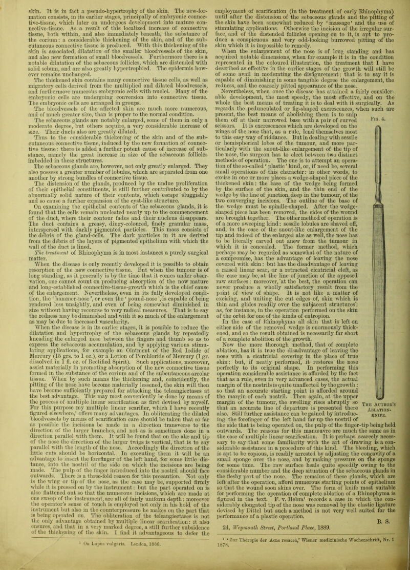 skin. It is in fact a pseudo-hypertrophy of the skin. The new-for- mation consists, in its earlier stages, principally of embryonic connec- tive-tissue, which later on \mdergoes development into mature con- nective-tissue. As a result of this localized increase of connective tissue, both within, and also immediately beneath, the substance of the corium; a considerable thickening of the skin, and of the sub- cutaneous connective tissue is produced. With this thickening of the skin is associated, dilatation of the smaller bloodvessels of the skin, and also new formation of small bloodvessels. Furthermore there is a notable dilatation of the sebaceous follicles, which are distended with solid sebum, and are also greatly hypertrophied. The epidermis how- ever remains unchanged. The thickened skin contains many connective tissue cells, as well as migratory cells derived from the multiplied and dilated bloodvessels, and ftirthermore numerous embryonic cells with nuclei. Many of the embryonic cells are i;ndergoing conversion into connective tissue. The embryonic cells are arranged in groups. The bloodvessels of the afected skin are much more numerous, and of much greater size, than is proper to the normal condition. The sebaceous glands are notably enlarged, some of them in only a moderate degree, but others acquire, a very considerable increase of size. Their ducts also are greatly dilated. Thus to the considerable thickening of the skin and of the sub- cutaneous connective tissue, induced by the new formation of connec- tive tissue: there is added a further potent cause of increase of sub- stance, namely the great increase in size of the sebaceous follicles imbedded in these structures. The sebaceous glands are, however, not only greatly enlarged. They also possess a greater number of lobules, which are separated from one another by strong bundles of connective tissue. The distension of the glands, produced by the undue proliferation of their epithelial constituents, is still further contributed to by the abnormally solid nature of their contents, which escape sluggishly and so cause a further expansion of the cyst-like structure. On examining the epithelial contents of the sebaceous glands, it is found that the cells remain nucleated nearly up to the commencement of the duct, where their contour fades and their nucleus disappears. The duct contains a greasy, dingy-coloured, finely granular mass, interspersed with darkly pigmented particles. This mass consists of the debris of the gland-cells. The dark particles in it are derived from the debris of the layers of pigmented epithelium with which the wall of the duct is lined. The treatment of Ehinophyma is in most instances a imrely surgical matter. When the disease is only recently developed it is possible to obtain resorption of the new connective tissue. But when the tumour is of long standing, as it generally is by the time that it comes under obser- vation, one cannot count on producing absorption of the now mature and long-established connective-tissue-growth which is the chief cause of the enlargement. Nevertheless, even in its fully developed condi- tion, the ‘ hammer-nose ’, or even the ‘ pound-nose ’, is capable of being rendered less unsightly, and even of being somewhat diminished in size without having recourse to very radical measures. That is to say the redness may be diminished and with it so much of the enlargement as may be due to increased vascularity. When the disease is in its earlier stages, it is possible to reduce the dilatation and hypertrophy of the sebaceous glands by repeatedly kneading the enlarged nose between the fingers and thumb so as to express the sebaceous accumulation, and by applying various stimu- lating applications, for example an Ointment of the Bed Iodide of Mercury (15 grs. to I oz.), or a Lotion of Perchloride of Mercury (1 gr. dissolved in I fl. oz. of Eectified Si)ii'it). Such api)lications, moreover, assist materially in promoting absorption of the new connective tissue formed in the substance of the corium and of the subcrrtaneous areolar tissrre. When by such means the thickening and, coincidently, the pitting of the nose have become materially lessened, the skin will then have become srrfficiently prepared for attacking the teleangiectases at the best advantage. This may most conveniently be done by means of the process of multiple linear scarification as first devised by myself. For this purpose my multiple linear scarifier, which I have recently figured elsewhere,' offers many advantages. In obliterating the dilated bloodvessels by means of scarification care should be taken that so far as possible the incisions be made in a direction transverse to the direction of the larger branches, and not as is sometimes done in a direction parallel with them. It will be found that on the alae and tip of the nose the direction of the larger twigs is vertical, that is to say parallel with the length of the nose. Accordingly the direction of the little cuts should be horizontal. In executing them it will be an advantage to insert the forefinger of the left hand, for some little dis- tance, into the nostril of the side on which the incisions are being made. The pulp of the finger introduced into the nostril should face outwards. There is a three-fold reason for this precaution. Not only is the wing or tip of the nose, as the case may be, supported firmly while it is pressed on by the instrument; biit the jjart operated on is also flattened out so that the numerous incisions, which are made at one sweej) of the instrument, are all of fairly uniform depth; moreover the operator’s sense of touch is employed not only in his hold of the instrument but also in the counterpressurc he makes on the part that is being operated on. The obliteration of the teleangiectases is not the only advantage obtained by multiple linear scarification: it also ensures, and that in a very marked degree, a still further subsidence of the thickening of the skin. I find it advantageous to defer the ' On Lujius vulgaris. LenJon, 1888. Fig. 4. employment of scarification (in the treatment of early Ehinophyma) until after the distension of the sebaceous glands and the pitting of the skin have been somewhat reduced by ‘ massage ’ and the use of stimulating applications. Otherwise the incision of the hregular sur- face, and of the distended folhcles opening on to it, is apt to pro- duce a conspicuous and very odd-looking burrowed jiitting of the skin which it is impossible to remedy. When the enlargement of the nose is of long standing and has acquired notable dimensions, when for example it is in the condition reiiresented in the coloured illustration, the treatment that I have described as effective in the earlier stages of the growth will still be of some avail in moderating the disfigurement; that is to say it is capable of diminishing in some tangible degree the enlargement, the redness, and the coarsely pitted aiipearance of the nose. Nevertheless, when once the disease has attained a fairly consider- able development, the most speedy, the most effective, and on the whole the best means of treating it is to deal with it surgically. As regards the pedunculated or fig-shaped excrescences, when such are present, the best means of abolishing them is to snijD them off at their narrowed base with a pair of curved scissors. It is excrescences which are developed on the wings of the nose that, as a rule, lend themselves most to this easy way of riddance. But in dealing with sessile or hemispherical lobes of the tumoiu’, and more par- ticularly with the snout-like enlargement of the tip of the nose, the surgeon has to elect between two distinct methods of operation. The one is to attempt an opera- tion of the so-called ‘ plastic ’ land, or, if need be, several small operations of this character; in other words, to excise in one or more places a wedge-shaped piece of the thickened skin: the base of the wedge being formed by the surface of the skin, and the thin end of the wedge by the line of junction, deep in the tumour, of the two converging incisions. The outline of the base of the wedge must be spindle-shaped. After the wedge- shaped ihece has been removed, the sides of the wound are brought together. The other method of operation is of a more sweeping kind: sessile lobules are shaved off, and, in the case of the snout-like enlargement of the tip and indeed of the enlarged alje as well, the nose has to be literally carved out anew from the tumour in which it is concealed. The former method, which perhaps may be regarded as somewhat of the nature of a compromise, has the advantage of leaving the nose covered with skin: bub has the disadvantage of leaving a raised linear scar, or a retracted cicatricial cleft, as the case may be, at the line of junction of the api^osed raw surfaces: moreover, ‘at the best, the operation can never produce a wholly satisfactory result from the point of view of shape. It is not like a matter of excising, and uniting the cut edges of, skin which is thin and glides readily over the subjacent structures; as, for instance, in the operation performed on the skin of the orbit for one of the kinds of entropion. In the case of Ehinophyma all skin that is left on either side of the removed wedge is enormously thick- ened, and so the result obtained is necessarily far short of a complete abolition of the growth. Now the more thorough method, that of complete ablation, has it is true the disadvantage of leaving the nose with a cicatricial covering in the i:)lace of true skin; but, if neatly performed, it restores the nose perfectly to its original shai^e. In performing this operation considerable assistance is afforded by the fact that as a rule, even in very adxanced cases, the actual margin of the nostrils is quite unaffected by the growth : so that an accurate starting point is afforded around the margin of each nostril. Then again, at the upjier margin of the tumour, the swelling rises abruptly so that an accurate line of departure is presented there also. Still further assistance can be gained by introduc- ing the forefinger of the left hand far up the nostril of the side that is being operated on, the pulp of the finger-tip being held outwards. Tlie reasons for this manoeuvre are much the same as in the case of multiple linear scarification. It is perhaps scarcely neces- sary to say that some familiarity with the art of drawing is a con- siderable assistance in a procedure of this kind. The bleeding, which is apt to be copious, is readily arrested by adjusting the coimavity of a small sponge over the nose, and by making pressure on tne sponge for some time. The raw surface heals quite speedily owing to the considerable number and the deep situation of the sebaceous glands in the fleshy jiart of the nose. The remains of these glands, which are left after the operation, afford numerous starting points of epithelium so that the wound soon skins over. The form of knife most suitable for performing the operation of complete ablation of a Ehinophyma is figured in the text. F. v. Hebra' records a case in which the con- siderably elongated tip of the nose was removed by the elastic ligature devised by Bittel but such a method is not very well suited for the performance of a iilastic operation. B. S. 21, Weymouth Street, Portland Place, 1889. The Author’s Ablation- knife. ' ‘ Zur Therapie der Acne rosacea,’ Wiener naedizinische Wochenschrift, Nr. 1 1878.