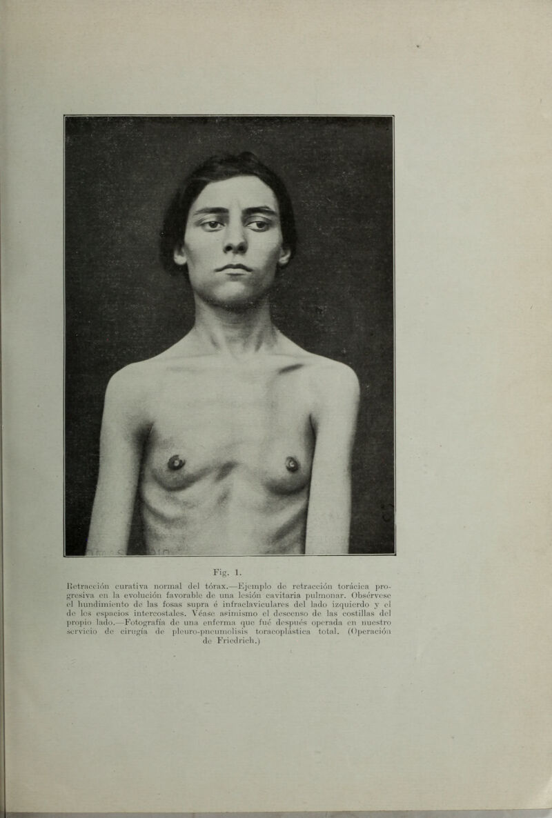 llctraf'cióii curativa normal del tórax.—Ejemplo de retracción torácica pro- gresiva en la evolución favorable de una lesión cavitaria pulmonar. Obsérvese el hundimiento de las fosas supra é infraclaviculares del lado izquierdo y el do los espacios intercostales. Véase asimismo el descenso de las costillas del ])ropio lado.—Fotografía de una enferma (pie fué después operada en nuestro servicio de cirugía de pleuro-pneumolisis toracoplástica total. (Ojieración de Friedricli.)