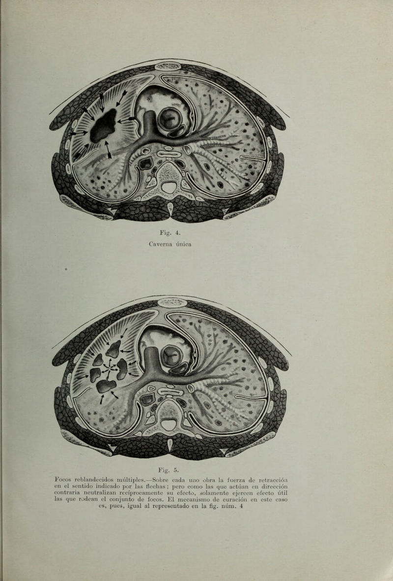 Caverna única Fig. 5. Focos reblandecidos múltiples.—Sobre cada uno obra la fuerza de retracción en el sentido indicado por las flechas ; pero como las que actúan en dirección contraria neutralizan recíprocamente su efecto, solamente ejercen efecto útil las que rodean el conjunto de focos. El mecanismo de curación en este caso es, pues, igual al representado en la fig. núrn. 4
