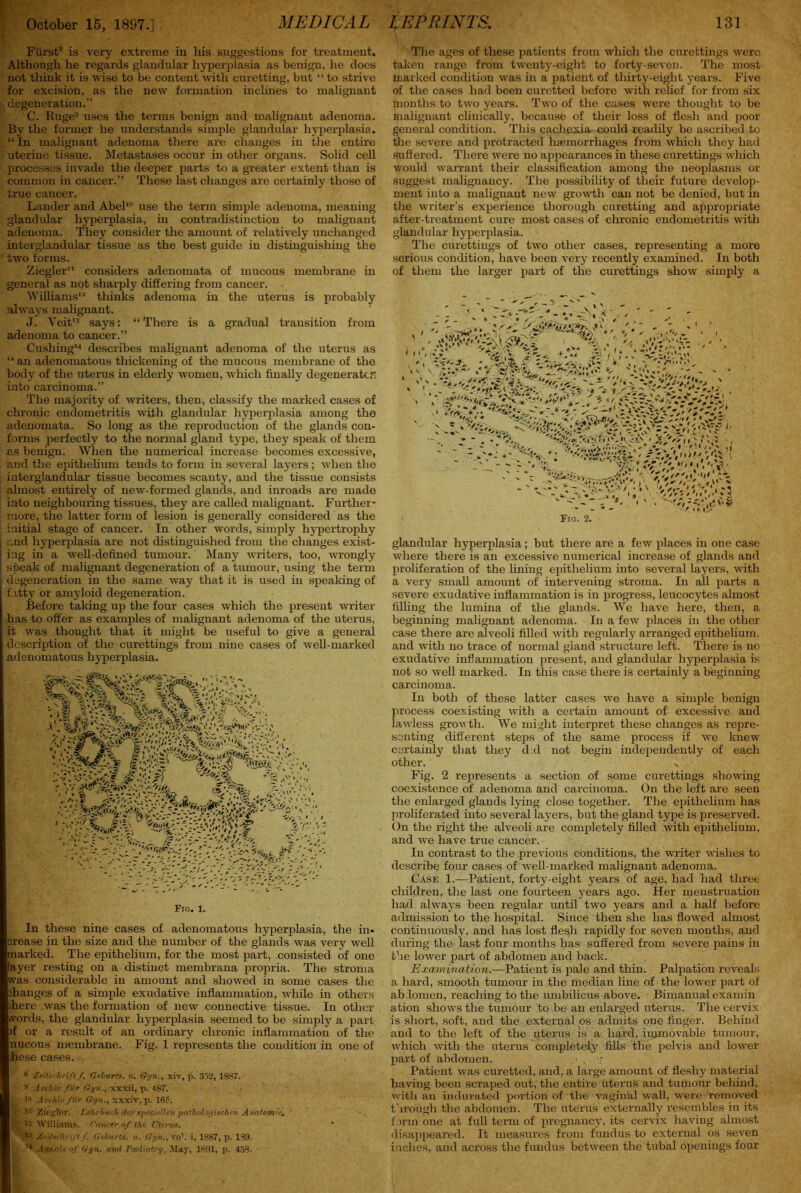 Ffirst8 is very extreme in his suggestions for treatment. Although he regards glandular hyperplasia as benign, he does not think it is wise to be content with curetting, but “ to strive for excision, as the new formation inclines to malignant degeneration.” C. Ruge9 uses the terms benign and malignant adenoma. By the former he understands simple glandular hyperplasia. “ In malignant adenoma there are changes in the entire uterine tissue. Metastases occur in other organs. Solid cell processes invade the deeper parts to a greater extent than is common in cancer.” These last changes are certainly those of true cancer. Lander and Abel10 use the term simple adenoma, meaning glandular hyperplasia, in contradistinction to malignant adenoma. They consider the amount of relatively unchanged interglandular tissue as the best guide in distinguishing the two forms. Ziegler” considers adenomata of mucous membrane in general as not sharply differing from cancer. Williams12 thinks adenoma in the uterus is probably always malignant. J. Veit13 says: “ There is a gradual transition from adenoma to cancer.” Cushing14 describes malignant adenoma of the uterus as “ an adenomatous thickening of the mucous membrane of the body of the uterus in elderly women, which finally degenerates into carcinoma.” The majority of writers, then, classify the marked cases of chronic endometritis with glandular hyperplasia among the adenomata. So long as the reproduction of the glands con- forms perfectly to the normal gland type, they speak of them as benign. When the numerical increase becomes excessive, and the epithelium tends to form in several layers ; when the interglandular tissue becomes scanty, and the tissue consists almost entirely of new-formed glands, and inroads are made into neighbouring tissues, they are called malignant. Further- more, the latter form of lesion is generally considered as the initial stage of cancer. In other words, simply hypertrophy and hyperplasia are not distinguished from the changes exist- ing in a well-defined tumour. Many writers, too, wrongly speak of malignant degeneration of a tumour, using the term degeneration in the same way that it is used in speaking of fatty or amyloid degeneration. Before taking up the four cases which the present writer has to offer as examples of malignant adenoma of the uterus, it was thought that it might be useful to give a general description of the curettings from nine cases of well-marked adenomatous hyperplasia. ''-'.vf- y 'K$*£•>!' dh '„*• i-'5* Fro. 1. In these nine cases of adenomatous hyperplasia, the in- crease in the size and the number of the glands was very well marked. The epithelium, for the most part, consisted of one layer resting on a distinct membrana propria. The stroma was considerable in amount and showed in some cases the changes of a simple exudative inflammation, while in others /here was the formation of new connective tissue. In other vords, the glandular hyperplasia seemed to be simply a part )f or a result of an ordinary chronic inflammation of the nucous membrane. Fig. 1 represents the condition in one of hese cases. ' € Zeit.srh riftf. Geburts. u, Gyn,5 xiv, p. 352, 1SS7. ‘ y Arehiv fiir Gyn.,xxxii, p. 487. 10 Arehivfiir Gyn., xxxiv,p. 16?. • 41 Ziegler. Lehrbuch-dei’speciEUen pathologischen Anatom>e, ’ %} 42 'VVilliarins. Crtricer of the Uterus. ;4;{ ZADchriftf. Geburts. u. Gyn., vo\ i, 1887, p. 1S9. oj’ Gyn. and Peediatry, May, 1891, p. 458. The ages of these patients from which the curettings were taken range from twenty-eight to forty-seven. The most marked condition was in a patient of thirty-eight years. Five of the cases had been curetted before with relief for from six months to two years. Two of the cases were thought to be malignant clinically, because of their loss of flesh and poor general condition. This cachexia could readily be ascribed to tile severe and protracted hemorrhages from which they had suffered. There were no appearances in these curettings which would warrant their classification among the neoplasms or suggest malignancy. The possibility of their future develop- ment into a malignant new growth can not be denied, but in the writer’s experience thorough curetting and appropriate after-treatment cure most cases of chronic endometritis with glandular hyperplasia. The curettings of two other cases, representing a more serious condition, have been very recently examined. In both of them the larger part of the curettings show simply a glandular hyperplasia; but there are a few places in one case where there is an excessive numerical increase of glands and proliferation of the lining epithelium into several layers, with a very small amount of intervening stroma. In all parts a severe exudative inflammation is in progress, leucocytes almost filling the lumina of the glands. We have here, then, a beginning malignant adenoma. In a few places in the other case there are alveoli filled with regularly arranged epithelium, and with no trace of normal gland structure left. There is no exudative inflammation present, and glandular hyperplasia is not so well marked. In this case there is certainly a beginning carcinoma. In both of these latter cases we have a simple benign process coexisting with a certain amount of excessive and lawless growth. We might interpret these changes as repre- senting different steps of the same process if we knew certainly that they dal not begin independently of each other. Fig. 2 represents a section of some curettings showing coexistence of adenoma and carcinoma. On the left are seen the enlarged glands lying close together. The epithelium has proliferated into several layers, but the gland type is preserved. On the right the alveoli are completely filled with epithelium, and we have true cancer. In contrast to the .previous conditions, the writer wishes to describe four cases of well-marked malignant adenoma. Case 1.—Patient, forty-eight years of age, had had three children, the last one fourteen years ago. Her menstruation had always been regular until two years and a half before admission to the hospital. Since then she has flowed almost continuously, and has lost flesh rapidly for seven months, and during the last four months has suffered from severe pains in the lower part of abdomen and back. Examination.—Patient is pale and thin. Palpation reveals a hard, smooth tumour in the median line of the lower part of ab lomen, reaching to the umbilicus above. Bimanual examin ation shows the tumour to be an enlarged uterus. The cervix is short, soft, and the external os admits one finger. Behind and to the left of the uterus is a hard, immovable tumour, which with the uterus completely fills the pelvis and lower part of abdomen. ,• . t Patient was curetted, and, a large amount of fleshy material having been scraped out, the entire uterus and tumour behind, with an indurated portion of the vaginal wall, were removed through the abdomen. The uterus externally resembles in its form one at full term of pregnancy, its cervix having almost disappeared. It measures from fundus to external os seven inches, and across the fundus between the tubal openings four