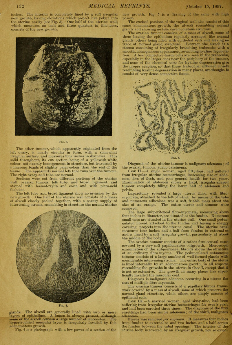 inches. The interior is completely lined by a soft irregular new growth, having elevations which project like polyp into the uterine cavity (see Pig. 3). One half of the uterine wall; which measures an inch and three quarters in thicl ness, consists of the new growth. Fig. 3. The other tumour, which apparently originated from the left ovary, is nearly circular in form, with a somewhat irregular surface, and measures four inches in diameter. It is solid throughout, its cut section being of a yellowish-white colour, not exactly homogeneous in structure, but traversed by numerous bands of slightly paler colour than the rest of the tissue. The apparently normal left tube runs over the tumour. The right ovary and tube are normal. Sections were cut from different portions of the uterine wall, ovarian tumour, left tube, and broad ligament, and stained with haemotoxylin and eosin and with picro-acid fuchsine. The left tube and broad ligament show no invasion by the new growth. One half of the uterine wall consists of a mass of alveoli closely packed together, with a scanty supply of intervening stroma, resembling in structure the normal uterine Fig. 4. glands. The alveoli are generally lined with two or more layers of epithelium. A lumen is always present, although some of the alveoli contain a large number of leucocytes. The hypertrophied muscular layer is irregularly invaded by this adenomatous growth. Fig. 4 is a photograph with a low power of a section of the new growth. Fig. 5 is a drawing of the same with high power. The excised portions of the vaginal wall also consist of this same adenomatous growth, the alveoli resembling normal glands and showing no true carcinomatous structure. The ovarian tumour consists of a mass of alveoli, some of them having the epithelium regularly arranged like normal glands, others being filled with epithelial cells and leaving no trace of normal glancl structure. Between the alveoli is a stroma consisting of irregularly branching trabeculae with a smooth, homogeneous appearance, resembling hyaline degenera- tion. A few connective-tissue cells are seen in the trabeculae, especially in the larger ones near the periphery of the tumour, and none of the chemical tests for hyaline degeneration give the proper reaction, so that these trabeculae, although closely resembling hyaline degeneration in many places, are thought to consist of very dense connective tissue. Diagnosis of the uterine tumour is malignant adenoma; of the ovarian tumour, adeno-carcinoma. Case II.—A single woman, aged fifty-four, had suffered from irregular uterine haemorrhages, increasing size of abdo- men, loss of flesh, and poor general health for two years. Examination of abdomen shows a hard, irregular-shaped tumour completely filling the lower half of abdomen and . pelvis. Laparotomy revealed a large uterus filled with fibro- : myomata, attached to the left of which, by means of the tube j and numerous adhesions, was a soft, friable mass about the j size of an orange. The entire uterus and tumour were : removed. The large subperitoneal fibro-myomata, measuring about four inches in diameter, are situated at the fundus. Numerous 1 small ones are situated in the uterine wall. One small pedun- culated fibroid, attached to the fundus and having a shaggy - covering, projects into the uterine canal. The uterine canal measures four inches and a half from fundus to external os and is lined by a soft, irregular growth, particularly at about the middle of the body. The ovarian tumour consists of a rather firm central mass covered by a very soft papillomatous outgrowth. Microscopic / examination of the subperitoneal fibroids shows the structure ; of an ordinary fibro-myoma. The pedunculated submucous 1 tumour consists of a large number of well-formed glands with J considerable intervening stroma. The entire body of the uterus j is lined internally by an adenomatous growth, in all respects I resembling the growths in the uterus in Case I, except that it •’ is not so extensive. The growth in many places has super- ficially invaded the muscular coat. Diagnosis is malignant adenoma occurring in a uterus the seat of multiple fibro-myomata. The ovarian tumour consists of a papillary fibrous frame- '< work covered by a mass of alveoli, some of which preserve the ' normal gland structure, while others are simply masses of epithelial cells. Case III.—A married woman, aged sixty-nine, had been i suffering from irregular uterine haemorrhages for over a year, and had been curetted three times. The diagnosis of the first curettings had been simple adenoma; of the third, malignant ^ adenoma. Uterus was removed per vaginam. It measures four inches from fundus to external os and two inches and a half across / the fundus between the tubal openings. The interior of the/ uterine body is covered by an irregular growth, not so exton- x