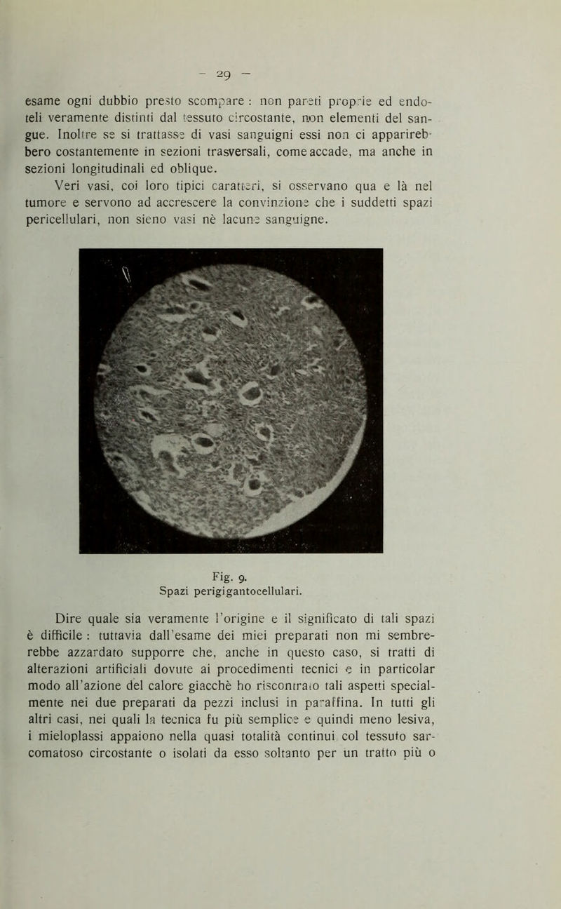 esame ogni dubbio presto scompare : non pareti proprie ed endo- teli veramente distinti dal tessuto circostante, non elementi del san- gue. Inoltre se si trattasse di vasi sanguigni essi non ci apparireb- bero costantemente in sezioni trasversali, come accade, ma anche in sezioni longitudinali ed oblique. Veri vasi, coi loro tipici caratteri, si osservano qua e là nel tumore e servono ad accrescere la convinzione che i suddetti spazi pericellulari, non sieno vasi nè lacune sanguigne. Fig. 9. Spazi perigigantocellulari. Dire quale sia veramente l’origine e il significato di tali spazi è difficile : tuttavia dall’esame dei miei preparati non mi sembre- rebbe azzardato supporre che, anche in questo caso, si tratti di alterazioni artificiali dovute ai procedimenti tecnici e in particolar modo all'azione del calore giacché ho riscontrato tali aspetti special- mente nei due preparati da pezzi inclusi in paraffina. In tutti gli altri casi, nei quali la tecnica fu più semplice e quindi meno lesiva, i mieloplassi appaiono nella quasi totalità continui col tessuto sar- comatoso circostante 0 isolati da esso soltanto per un tratto più 0