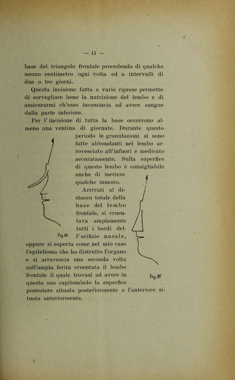 base del triangolo frontale procedendo di qualche mezzo centimetro ogni volta ed a intervalli di due o tre giorni.- Questa incisione fatta a varie riprese permette di sorvegliare bene la nutrizione del lembo e di assicurarmi ch’esso incomincia ad avere sangue dalla parte inferiore. Per 1’ incisione di tutta la base occorrono al- meno una ventina di giornate. Durante questo periodo le granulazioni si sono fatte abbondanti nel lembo ar- rovesciato all’infuori e medicato accuratamente. Sulla superfice di questo lembo è consigliabile anche di mettere qualche innesto. Arrivati al di- stacco totale della base del lembo frontale, si cruen- tava ampiamente tutti i bordi del- figm l’orifizio nasale, oppure si esporta come nel mio caso l’epitelioma che ha distrutto l’organo e si arrovescia una seconda volta sull’ampia ferita cruentata il lembo frontale il quale trovasi ad avere in questo suo capitombolo la superfice posteriore situata posteriormente e l’anteriore si- tuata anteriormente. hy.1V è