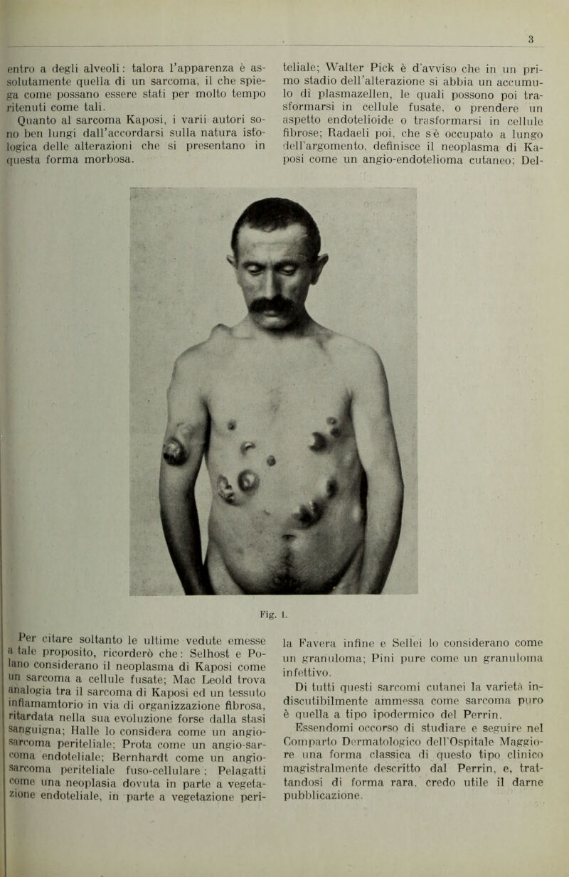 entro a degli alveoli : talora l’apparenza è as- solutamente quella di un sarcoma, il che spie- ga come possano essere stati per molto tempo ritenuti come tali. Quanto al sarcoma Kaposi, i varii autori so- no ben lungi dall’accordarsi sulla natura isto- logica delle alterazioni che si presentano in questa forma morbosa. teliate; Walter Pick è d’avviso che in un pri- mo stadio dell’alterazione si abbia un accumu- lo di plasmazellen, le quali possono poi tra- sformarsi in cellule fusate, o prendere un aspetto endotelioide o trasformarsi in cellule fibrose; Radaeli poi, che se occupato a lungo dell’argomento, definisce il neoplasma di Ka- posi come un angio-endotelioma cutaneo; Del- Fig. 1. Per citare soltanto le ultime vedute emesse a tale proposito, ricorderò che : Selhost e Pe- lano considerano il neoplasma di Kaposi come un sarcoma a cellule fusate; Mac Leold trova analogia tra il sarcoma di Kaposi ed un tessuto infiamamtorio in via di organizzazione fibrosa, ritardata nella sua evoluzione forse dalla stasi sanguigna; Halle lo considera come un angio- sarcoma periteliale; Prota come un angio-sar- c°ma endoteliale; Bernhardt come un angio- sarcoma periteliale fuso-cellulare ; Pelagatti come una neoplasia dovuta in parte a vegeta- zione endoteliale, in parte a vegetazione peri- la Favera infine e Sellei lo considerano come un granuloma; Pini pure come un granuloma infettivo. Di tutti questi sarcomi cutanei la varietà in- discutibilmente ammessa come sarcoma puro è quella a tipo ipodermico del Perrin. Essendomi occorso di studiare e seguire nel Comparto Dermatologico dell'Ospitale Maggio- re una forma classica di questo tipo clinico magistralmente descritto dal Perrin, e, trat- tandosi di forma rara, credo utile il darne pubblicazione.